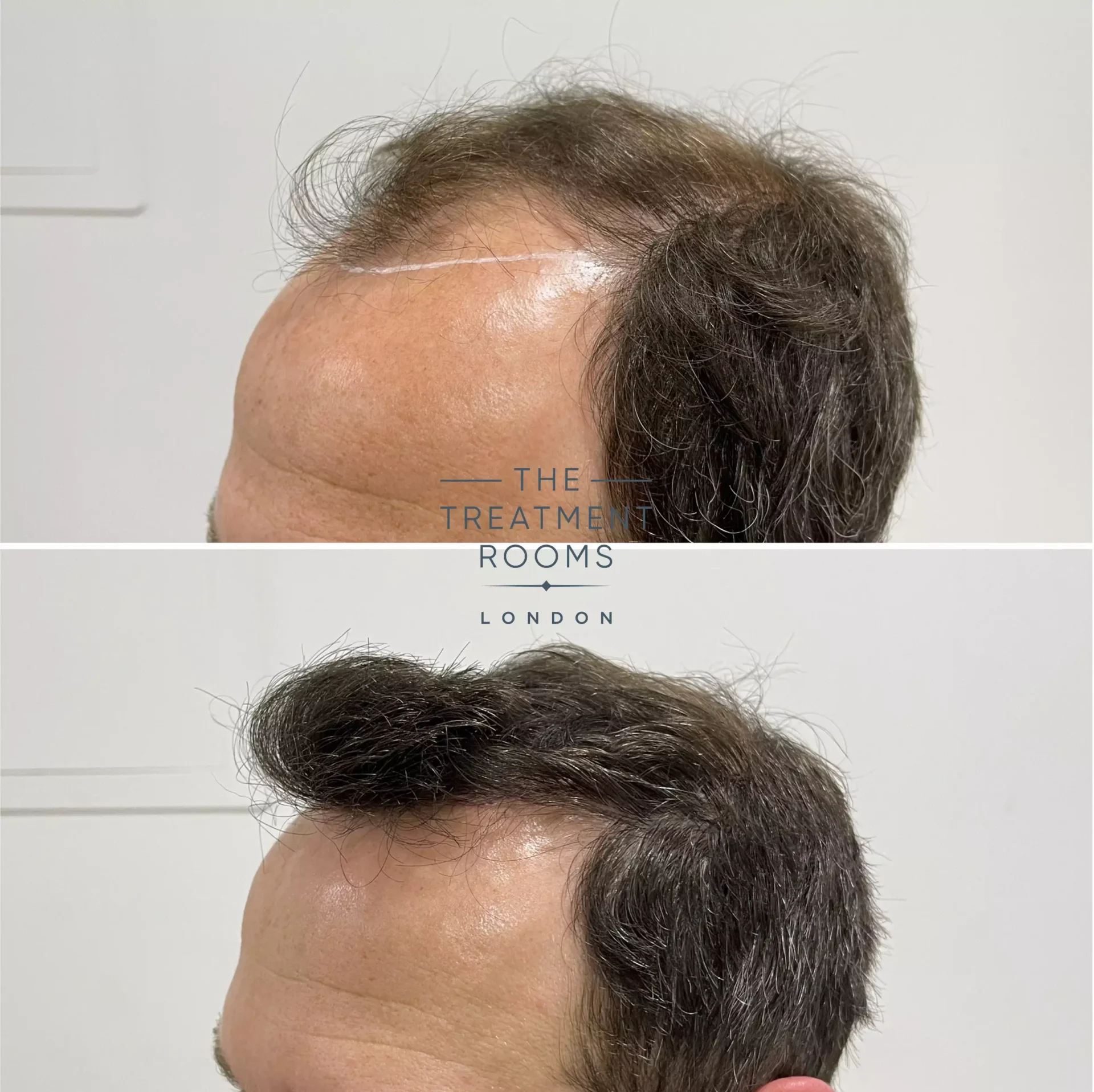 2076 grafts fue hair transplant result