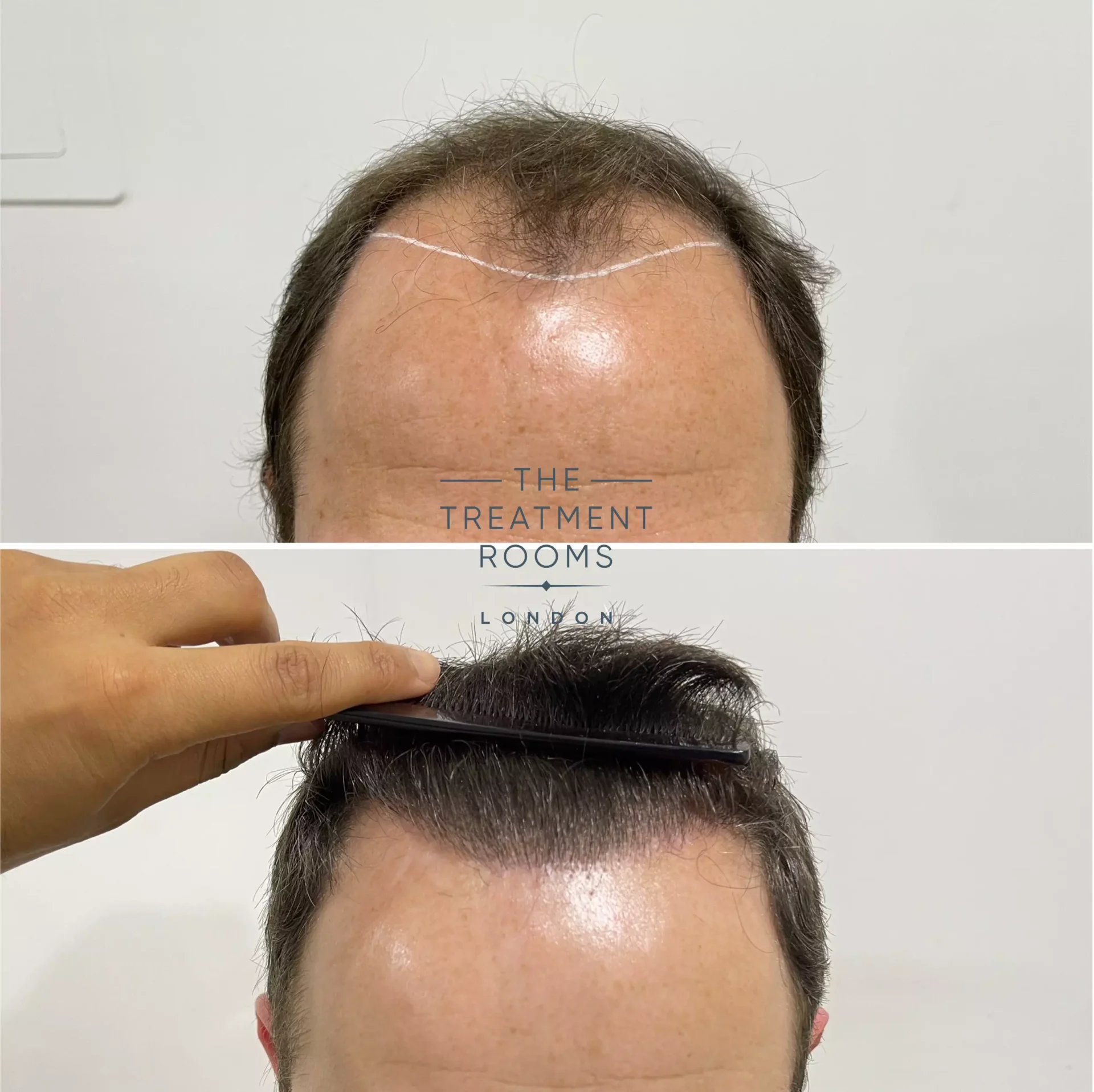 2076 grafts hair transplant result