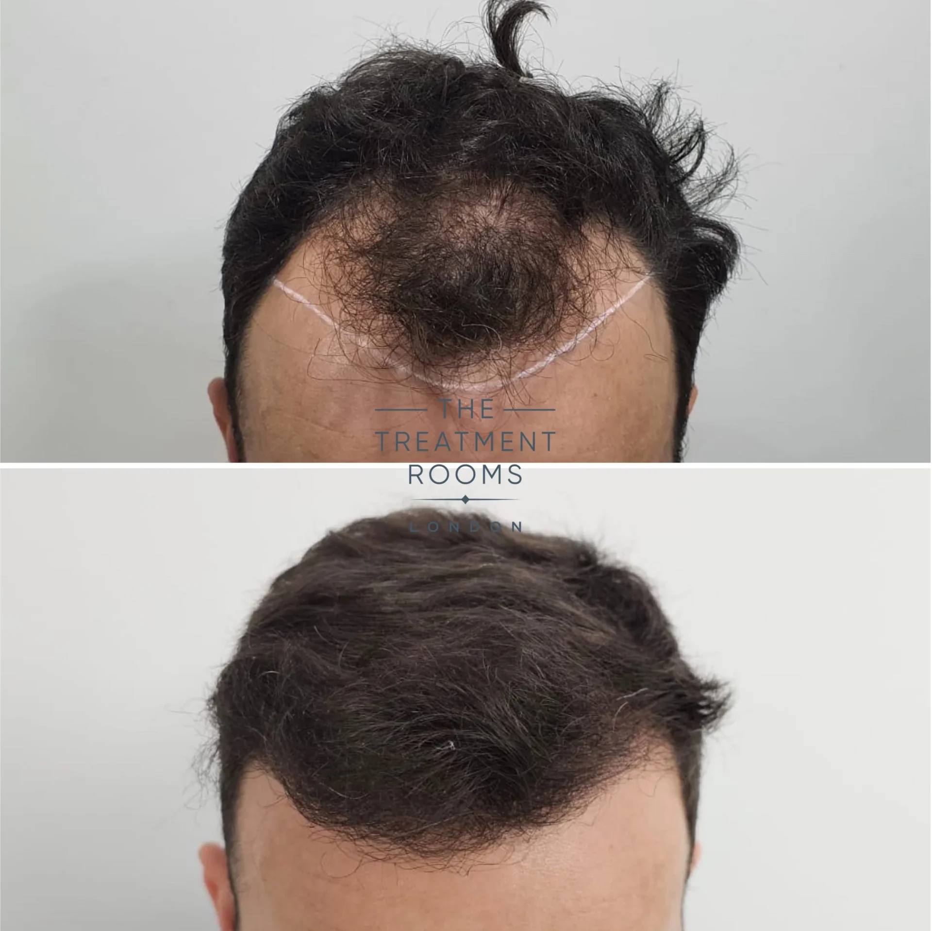 2128 grafts coarse hair transplant before and after