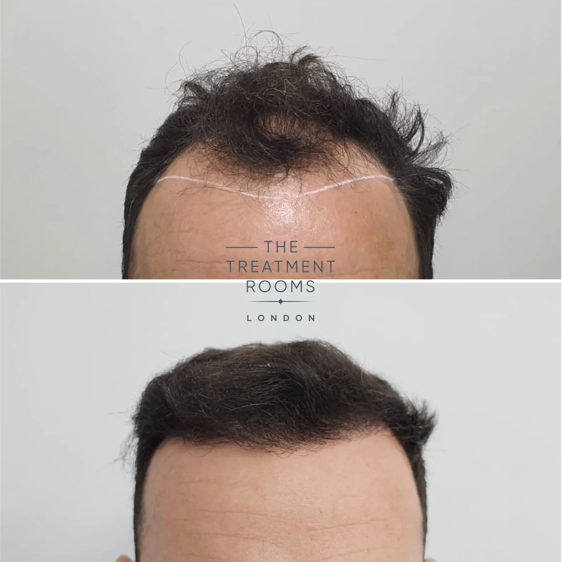 2128 grafts fue hair transplant before and after