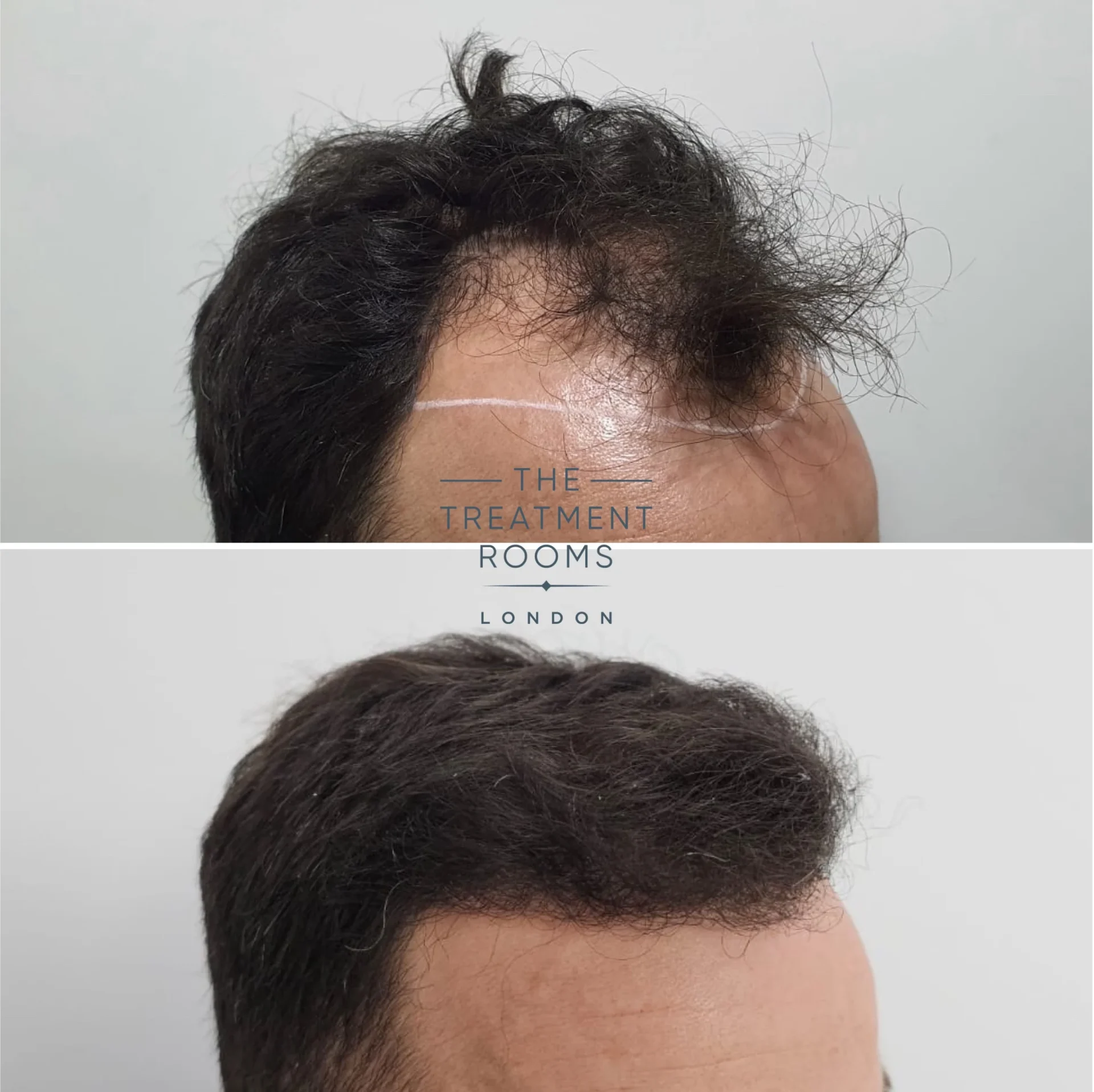 2128 grafts hair transplant before and after coarse hair