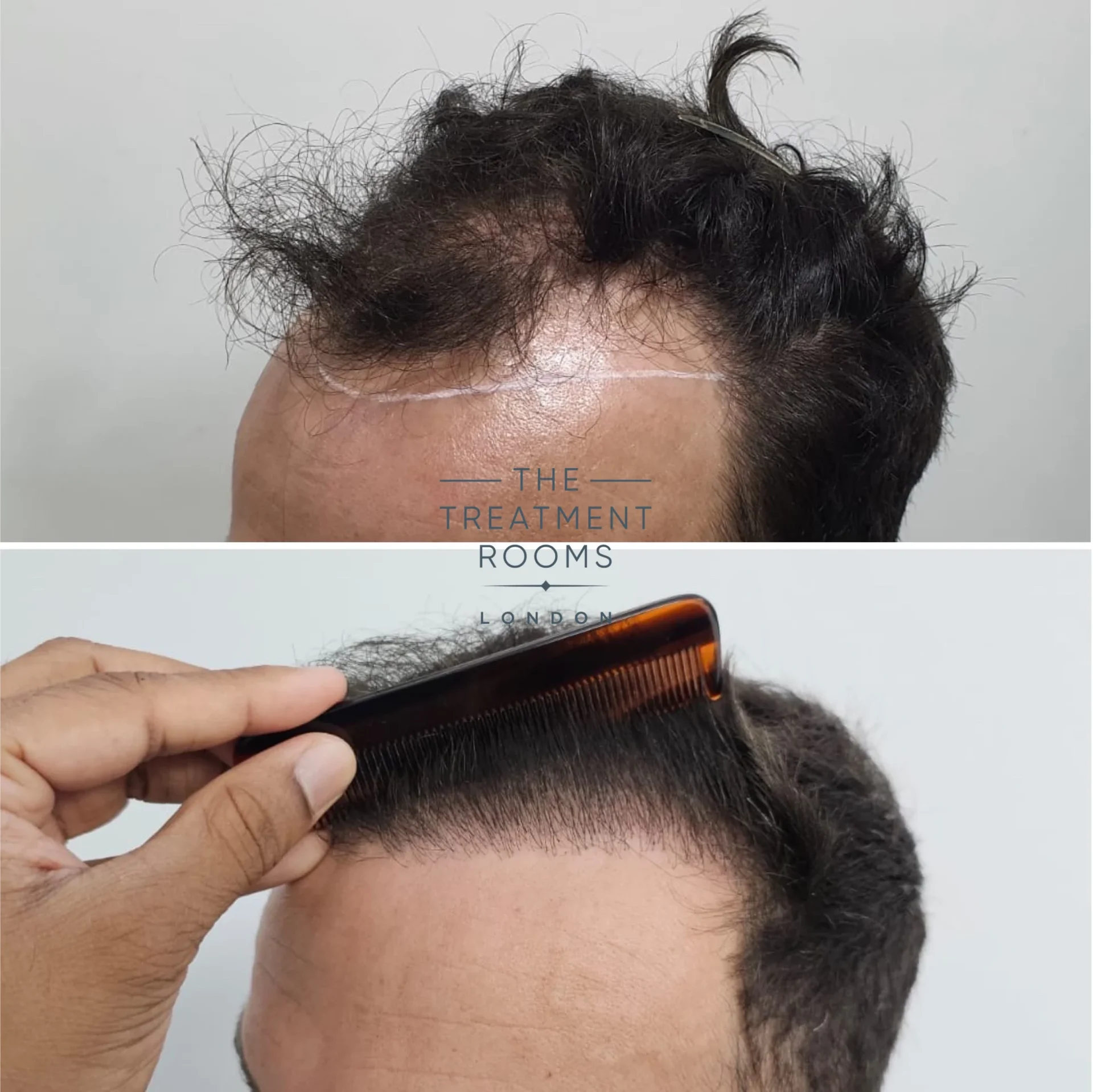 2128 grafts hair transplant before and after norwood 3