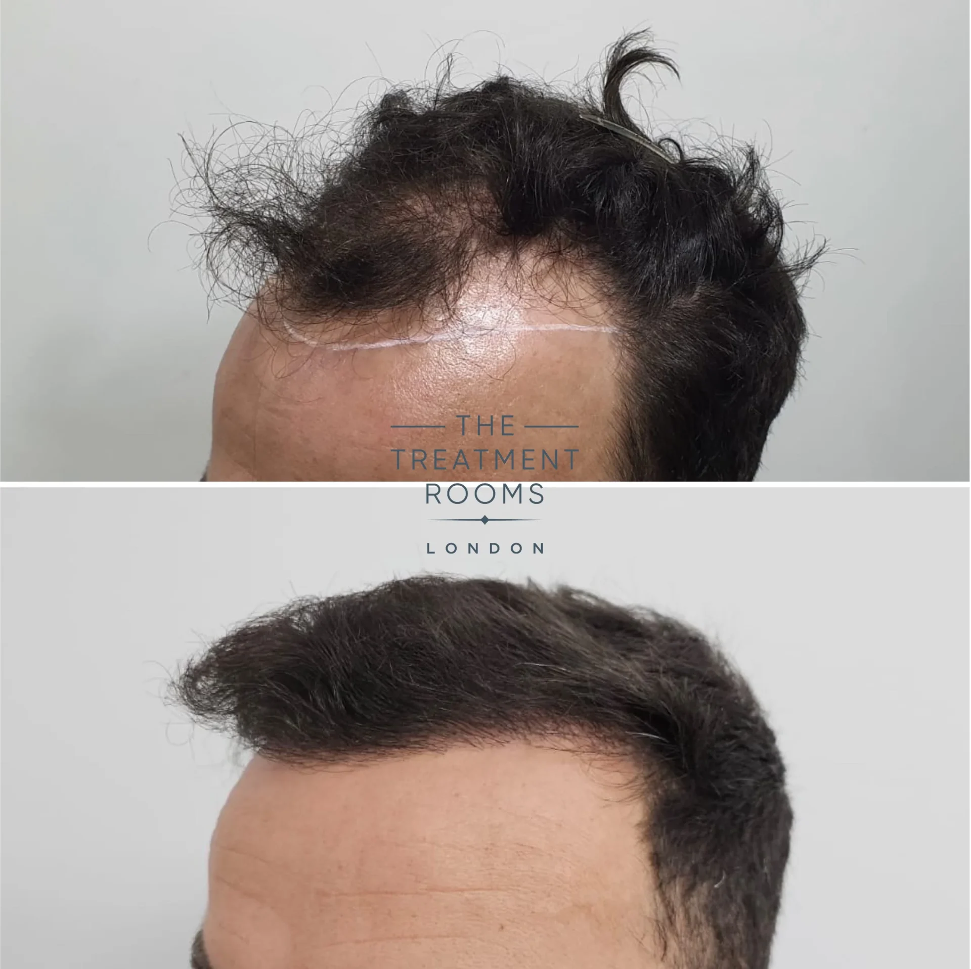 2128 grafts hair transplant before and after