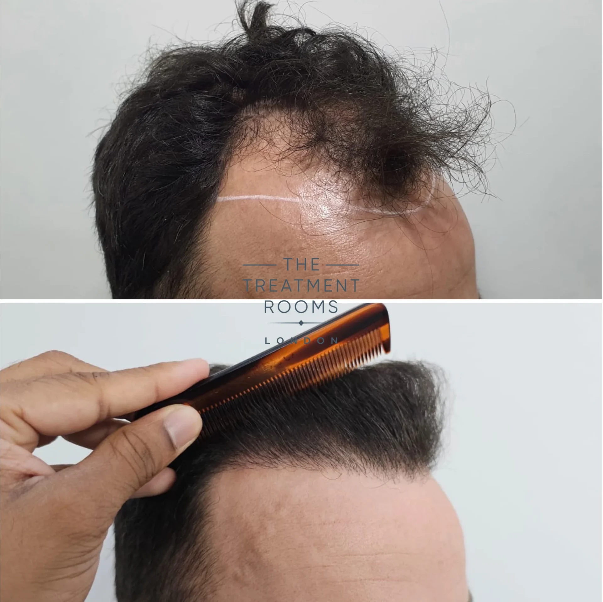 2128 grafts male hair transplant before and after