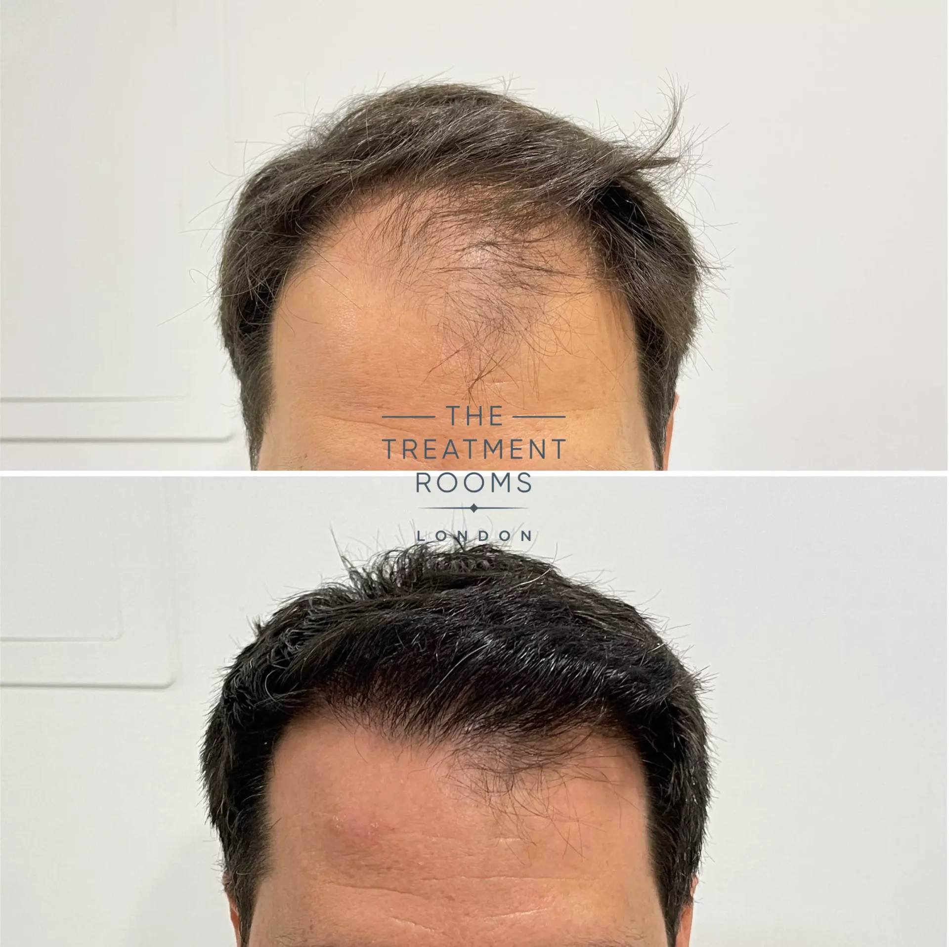 2170 grafts hairline fue hair transplant before and after
