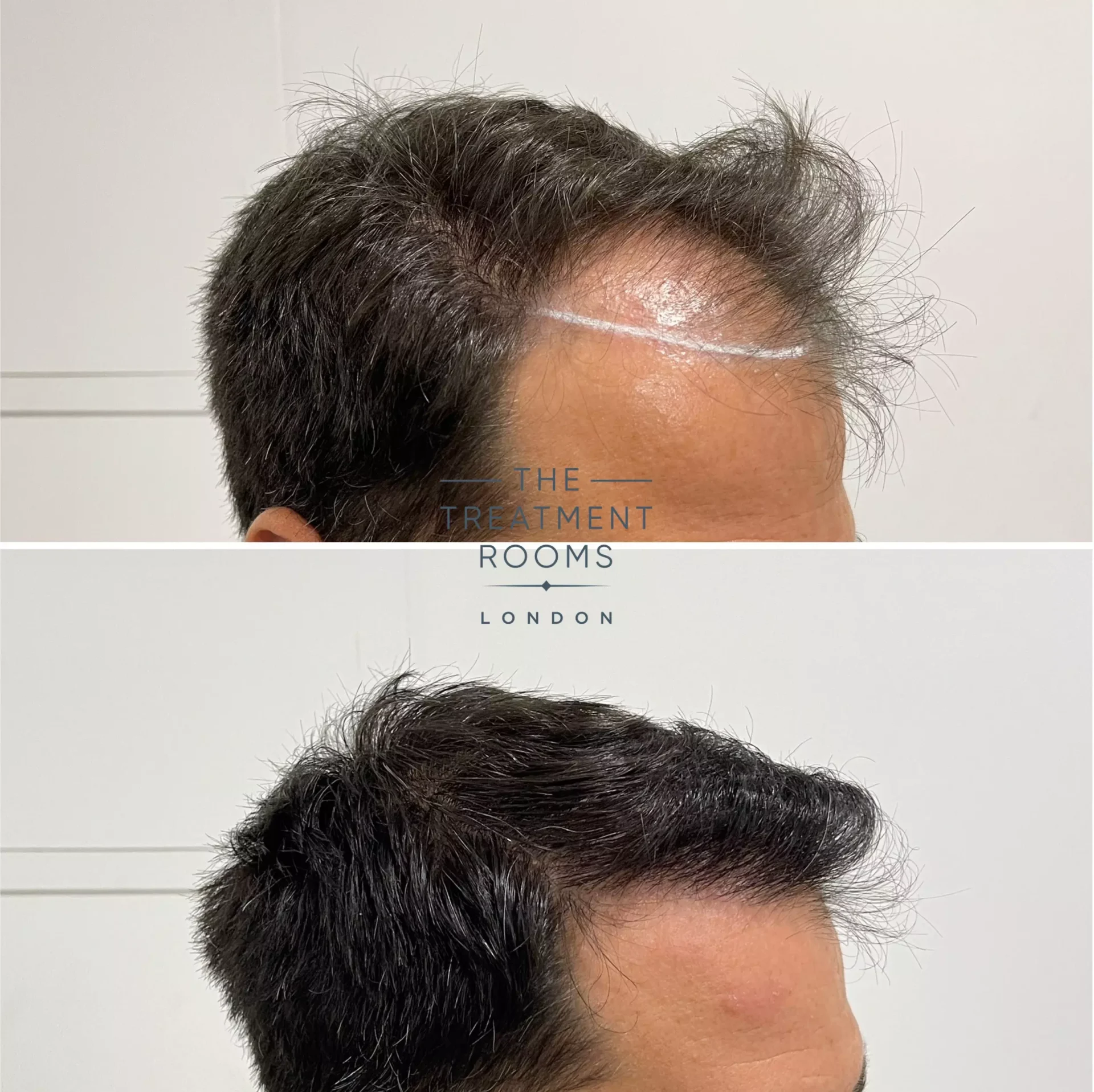 2170 grafts hairline fue hair transplant result