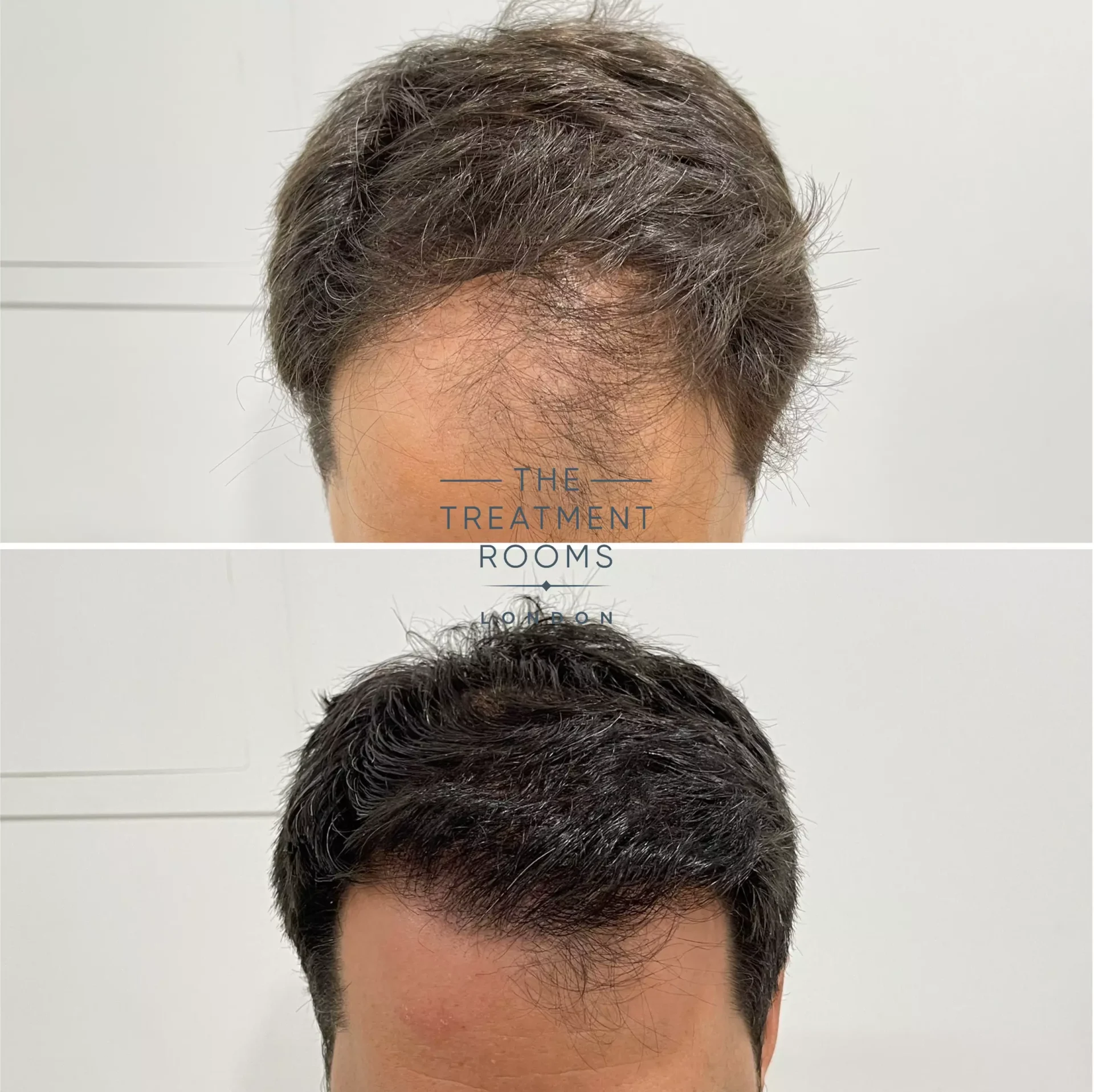 2170 grafts hairline hair transplant before and after