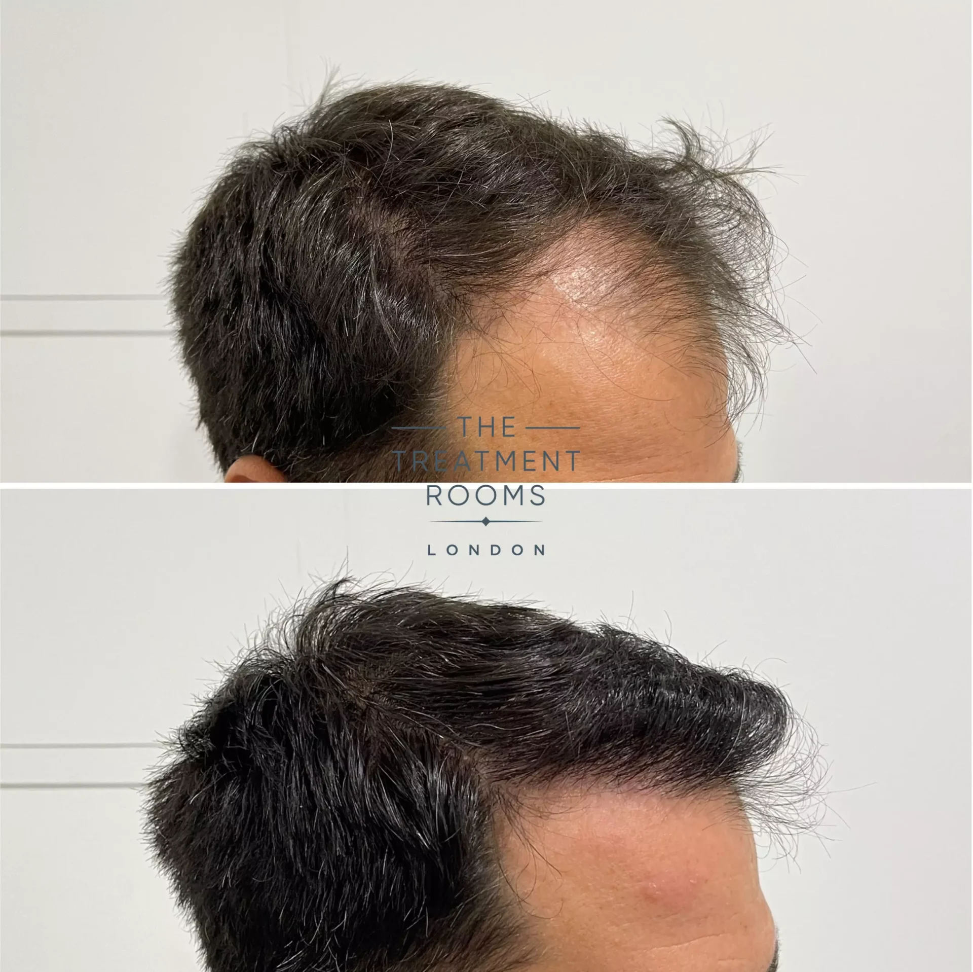 2170 grafts hairline hair transplant result