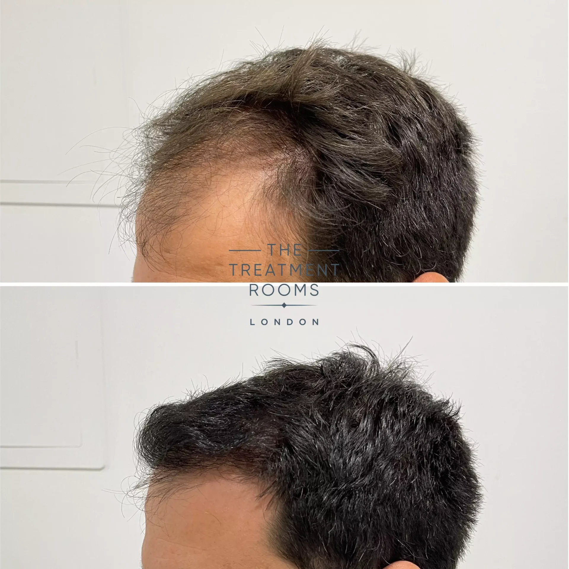 2170 grafts receding hairline hair transplant before and after