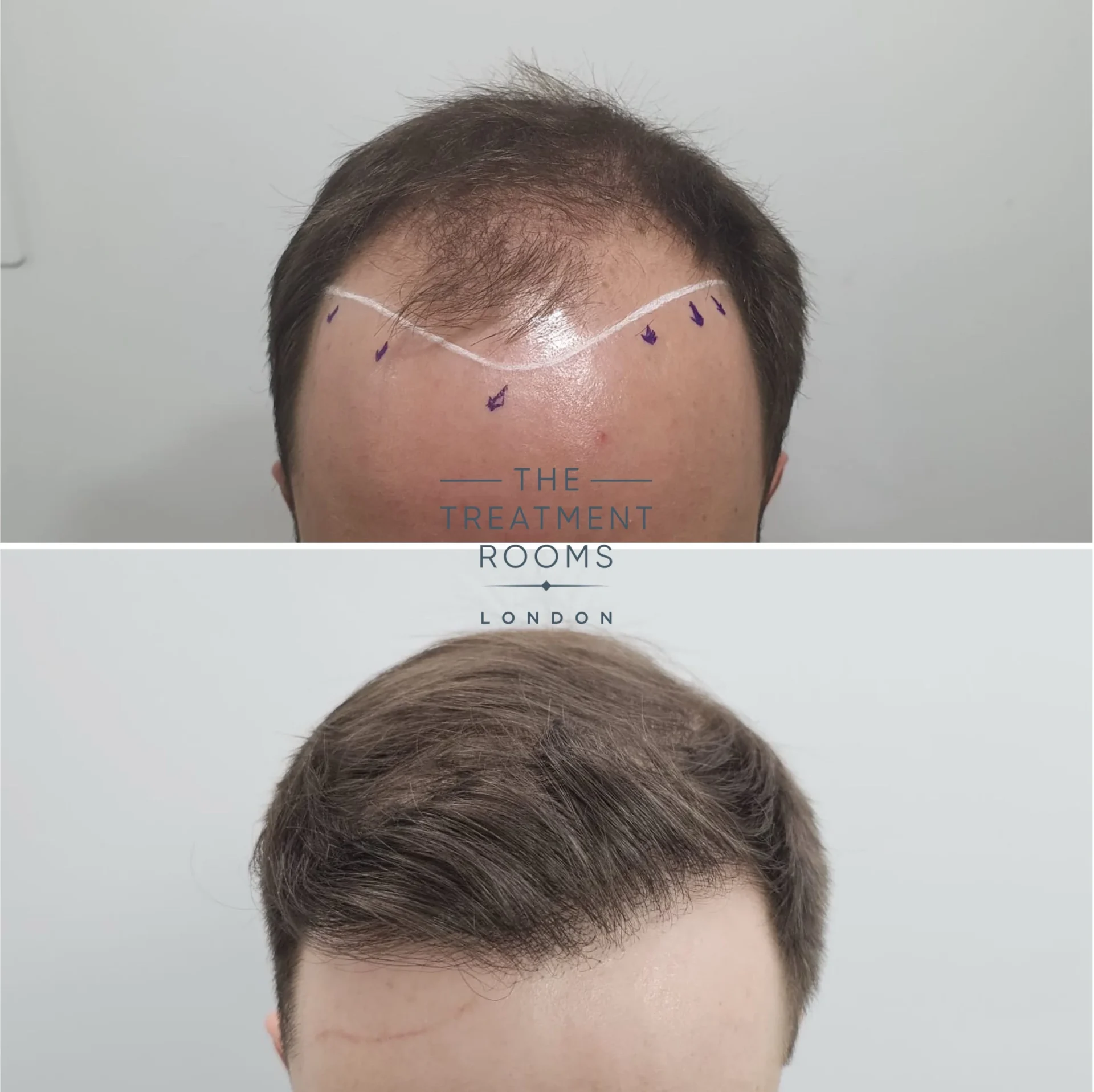 2187 grafts hair transplant hairline before and after