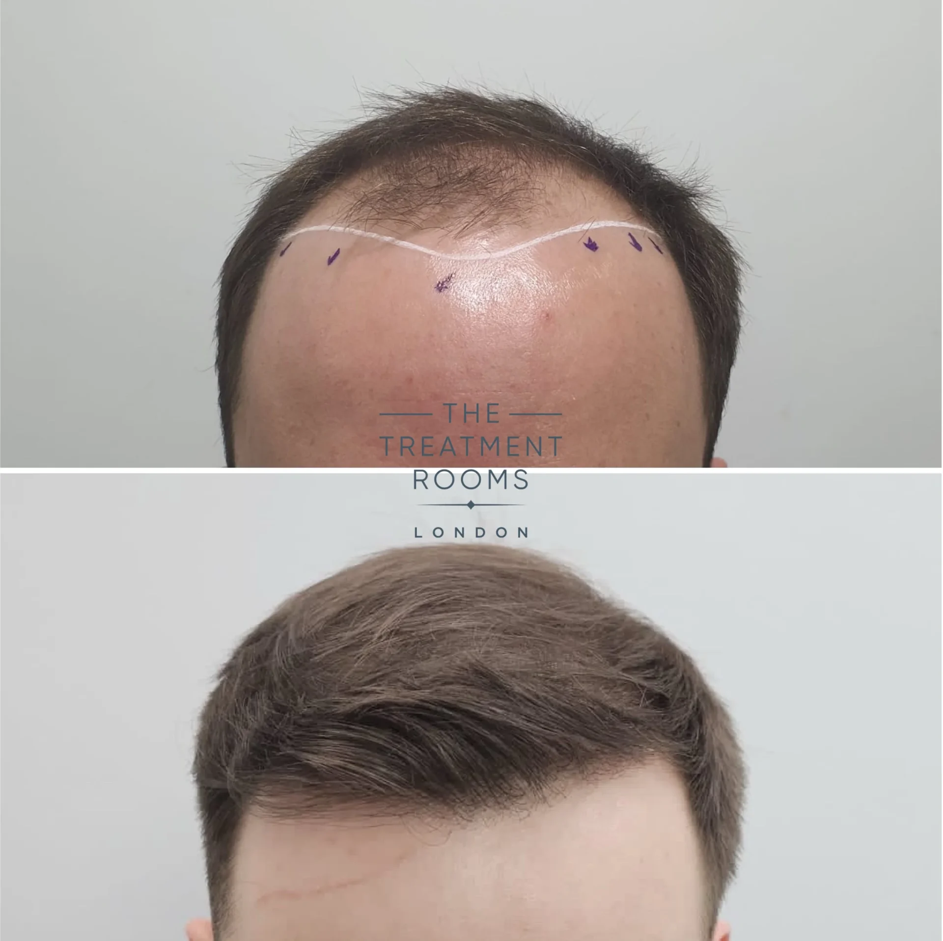 2187 grafts hairline fue transplant before and after