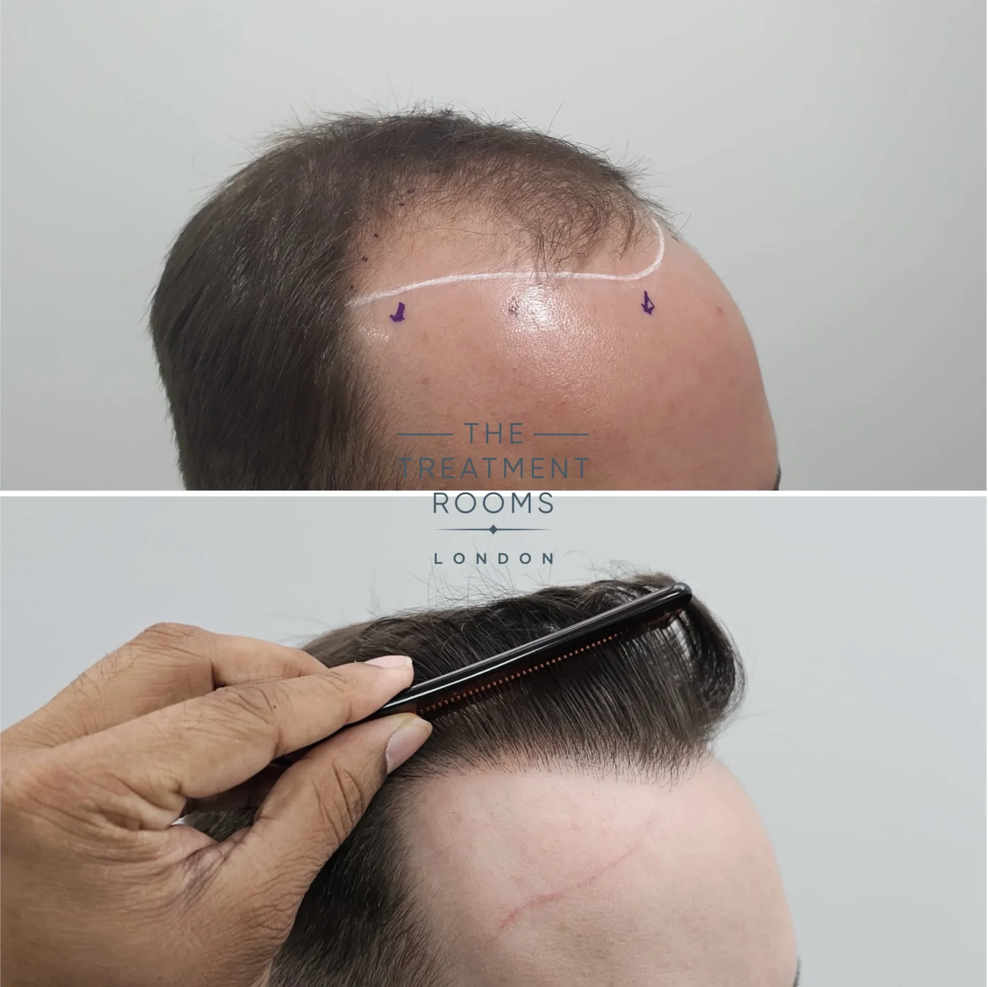 2187 grafts hairline fue transplant result