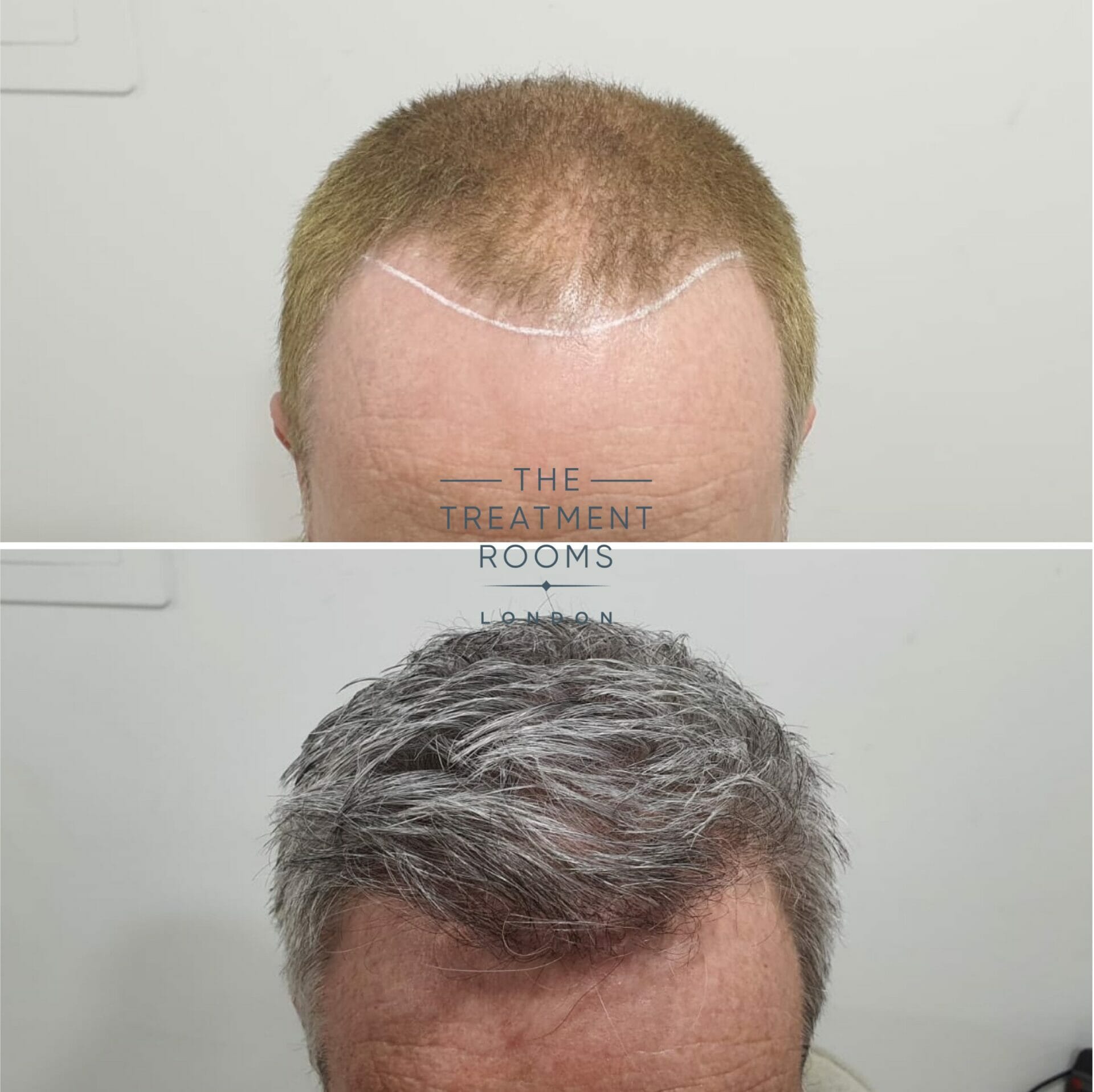 2322 graft fue hair transplant hairline and crown result