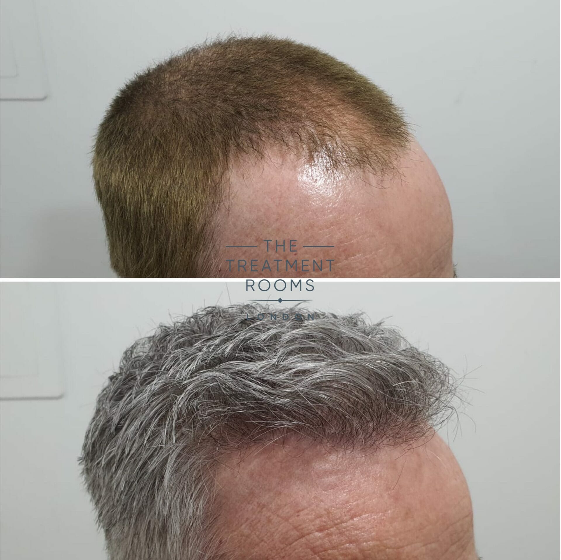 2322 graft fue hair transplant london result