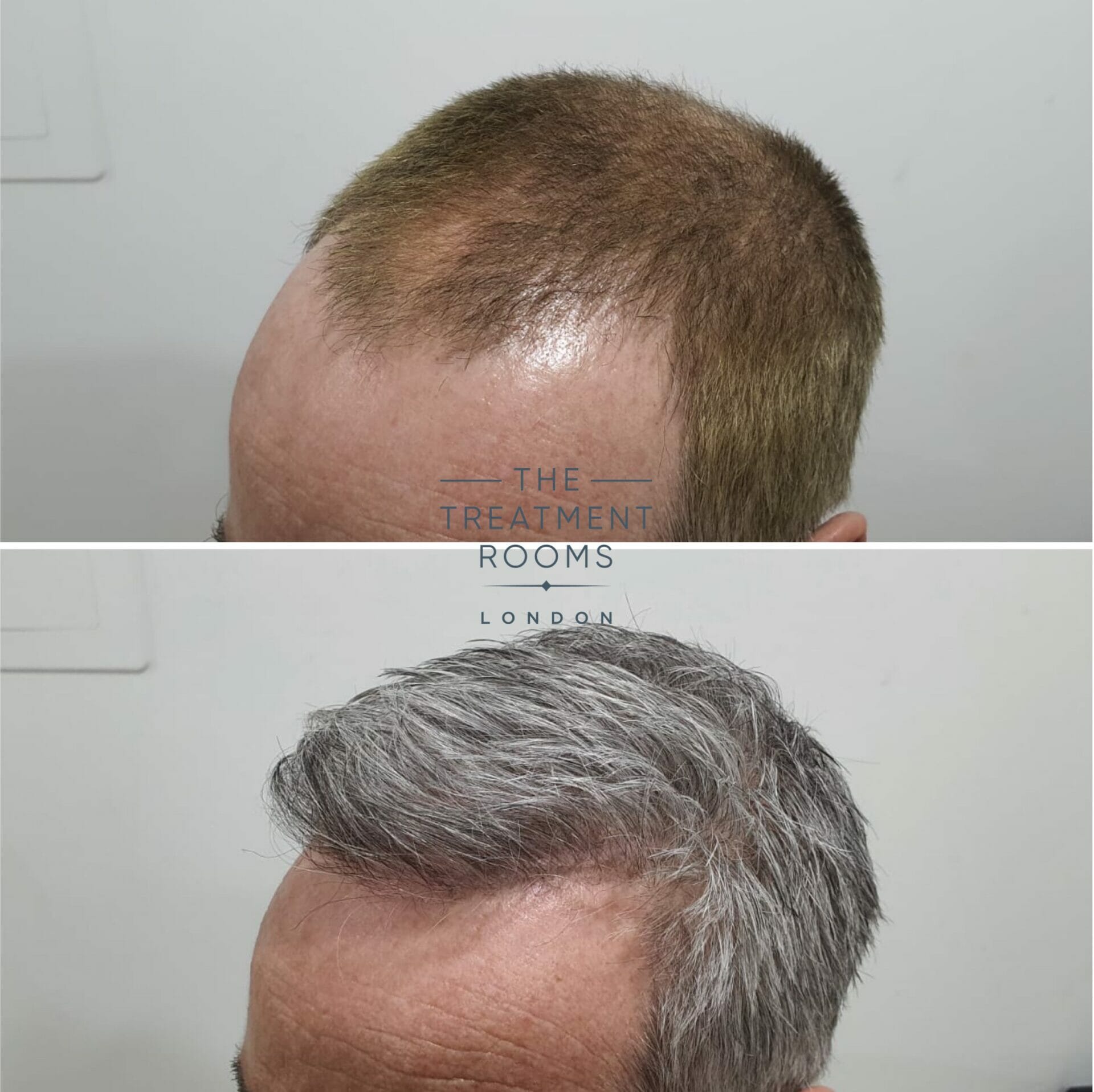 2322 graft hairline transplant result