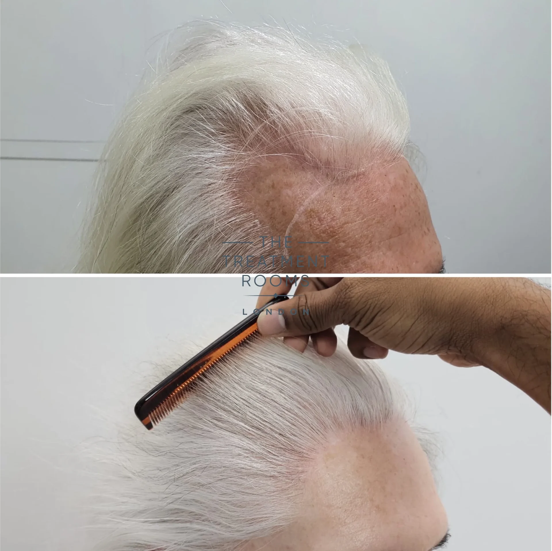 2390 grafts transgender fue hair transplant