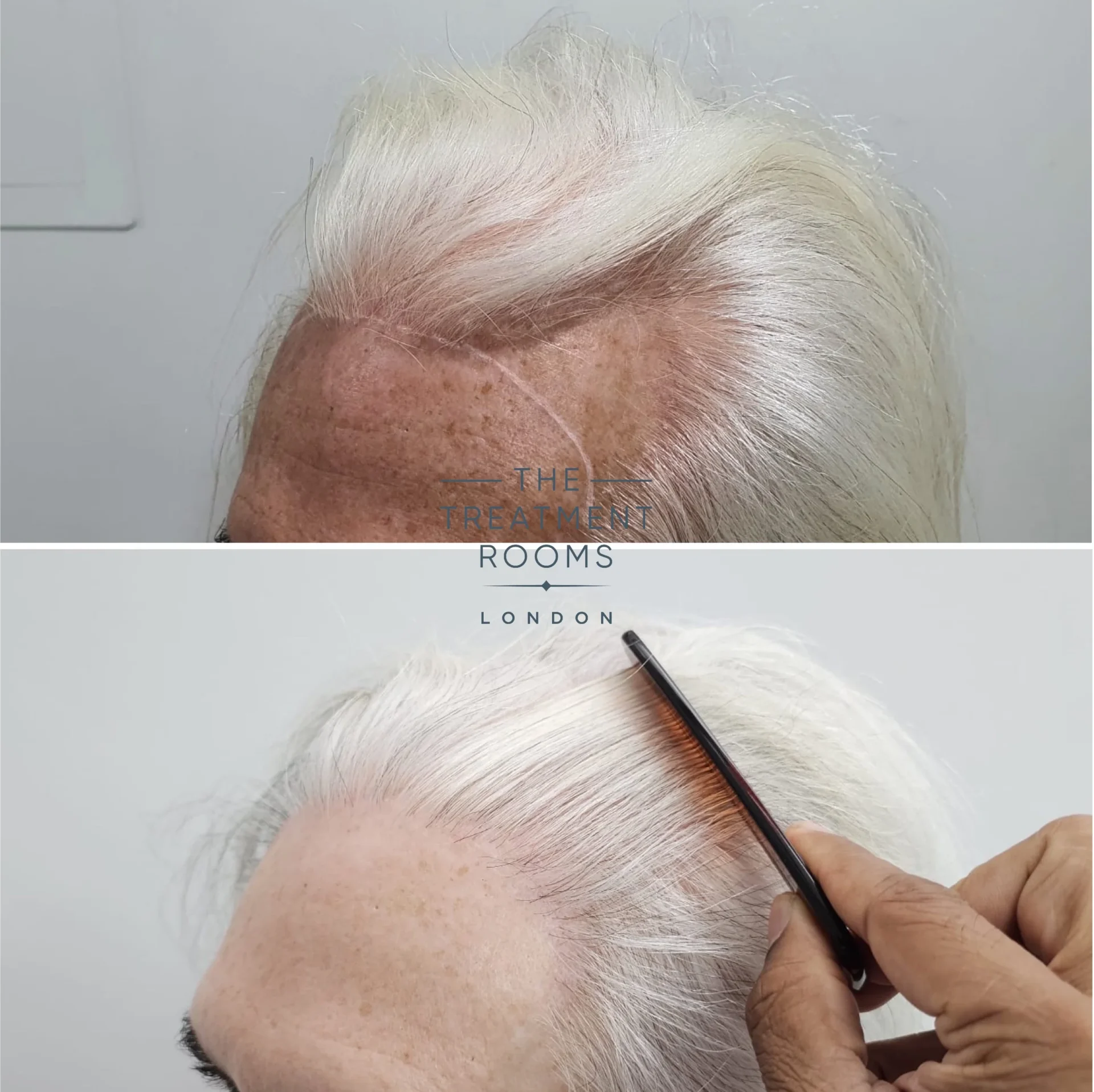 2390 grafts transgender hair transplant clinic london