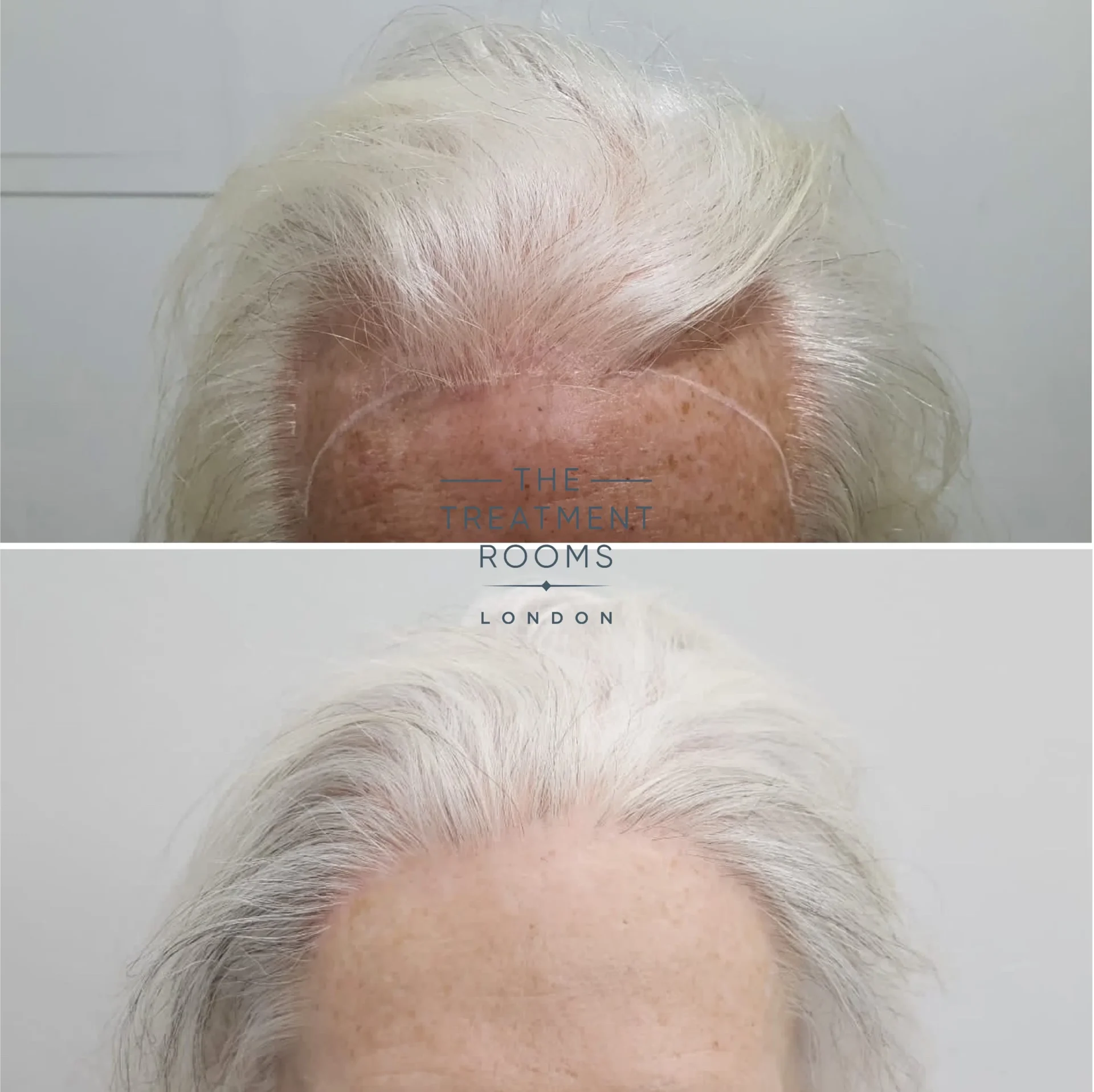 2390 grafts transgender hair transplant clinic 2390 grafts transgender hair transplant clinic