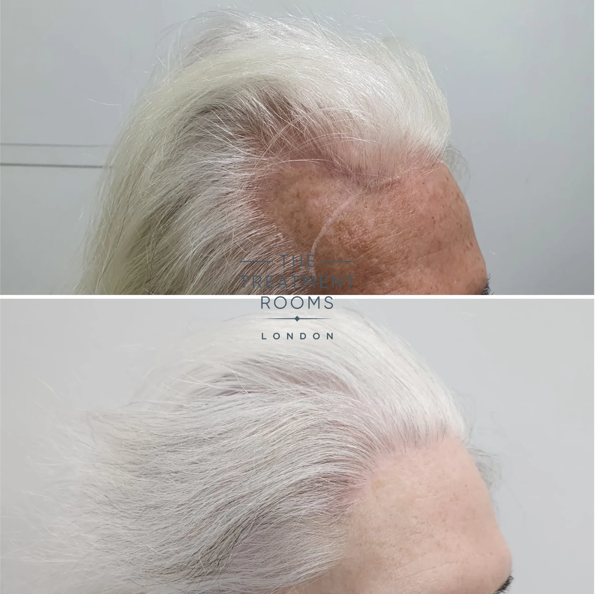 2390 grafts transgender hair transplant london