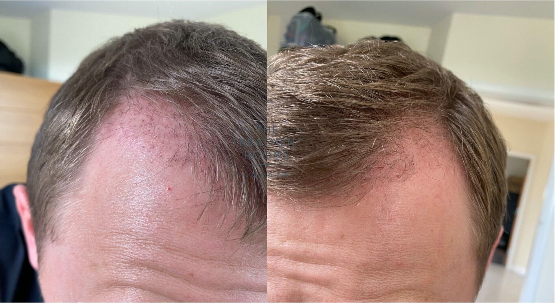3 months after hair transplant