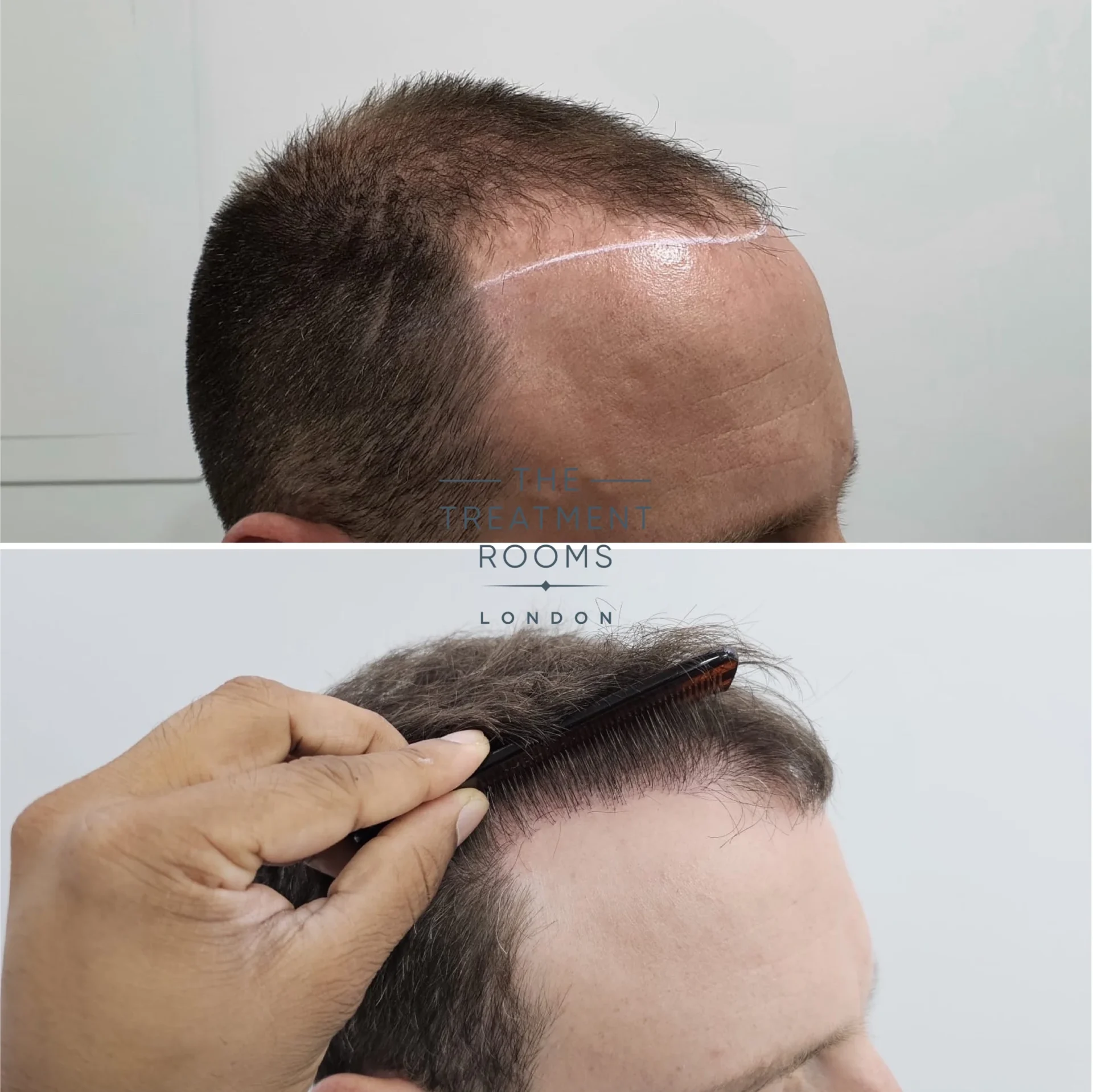 3299 grafts before and after hair transplant