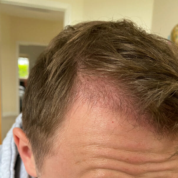 Hair transplant after one month - Treatment Rooms London