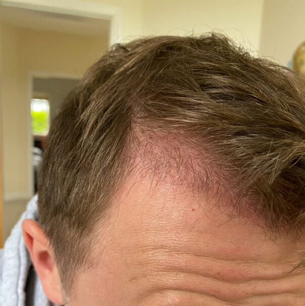 4 Months of Hair Transplant What To Expect  Pristyn Care