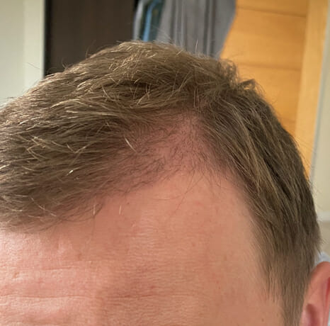 4 months after hair transplant