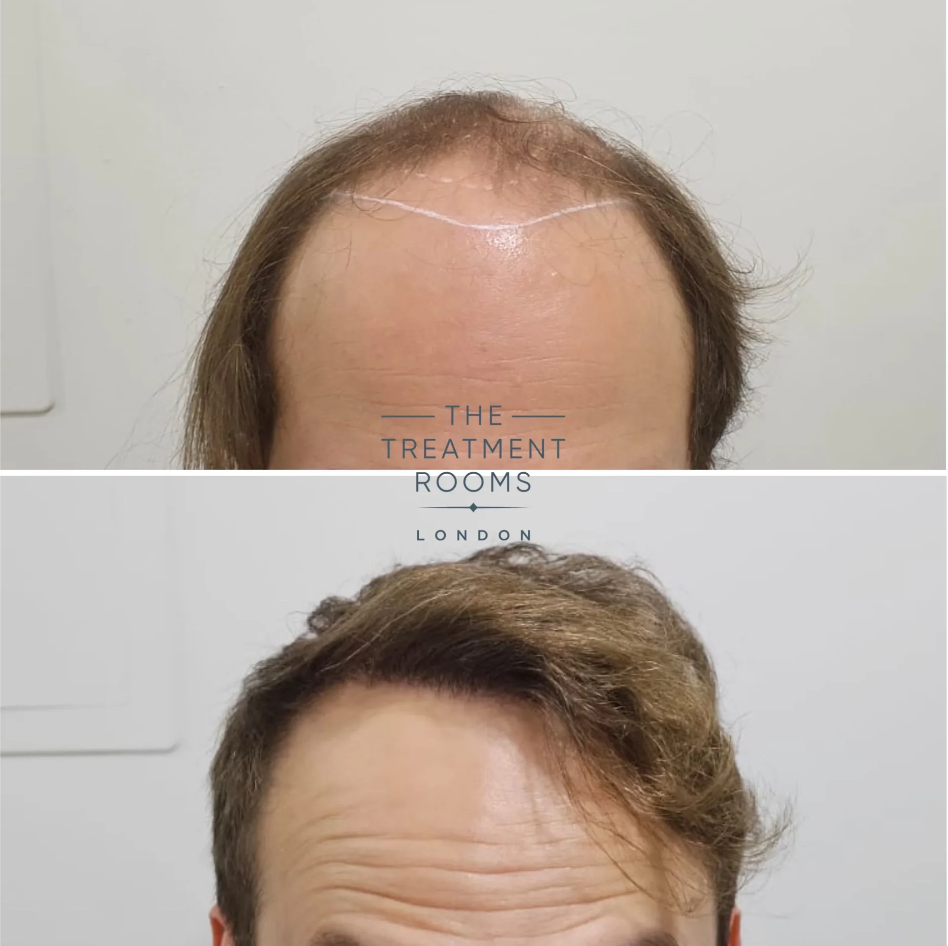 4111 grafts fue hair transplant before and after