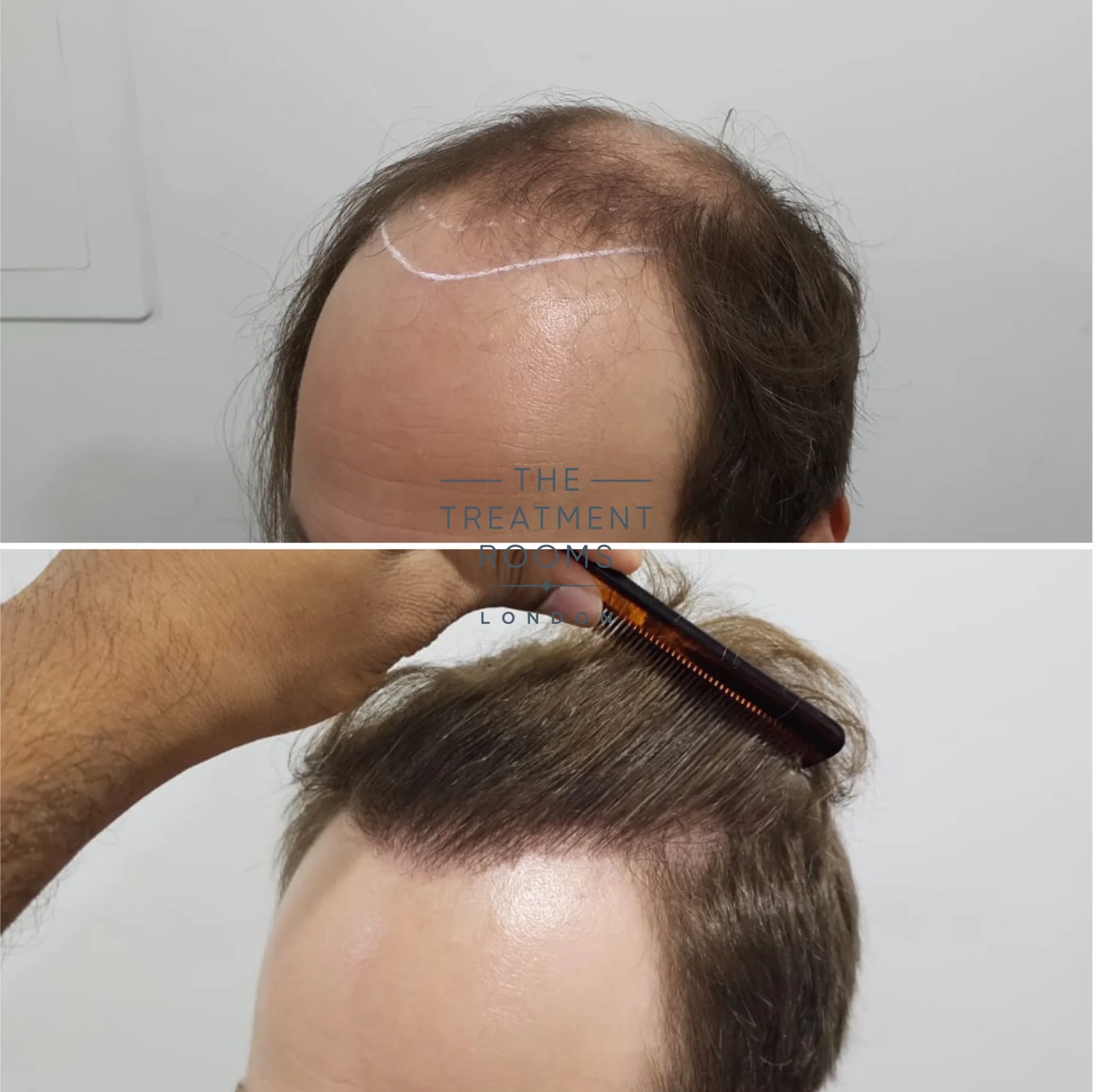 4111 grafts fue hair transplant hairline and crown before and after