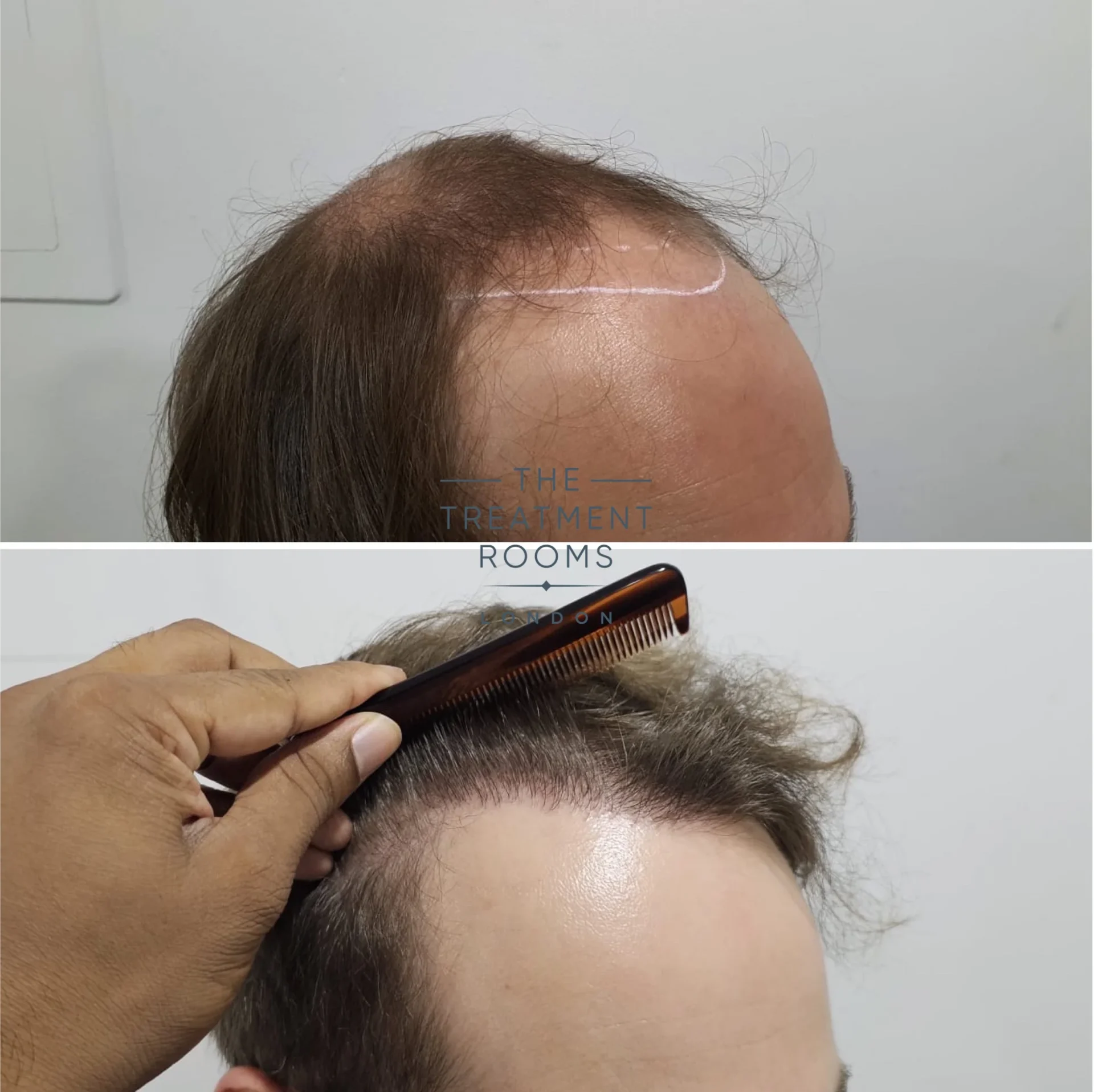 4111 grafts fue hair transplant hairline and crown result