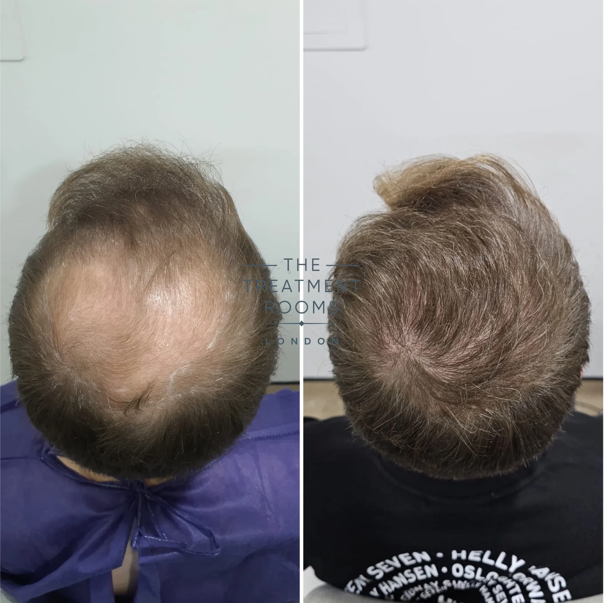 4111 grafts fue hair transplant hairline and crown