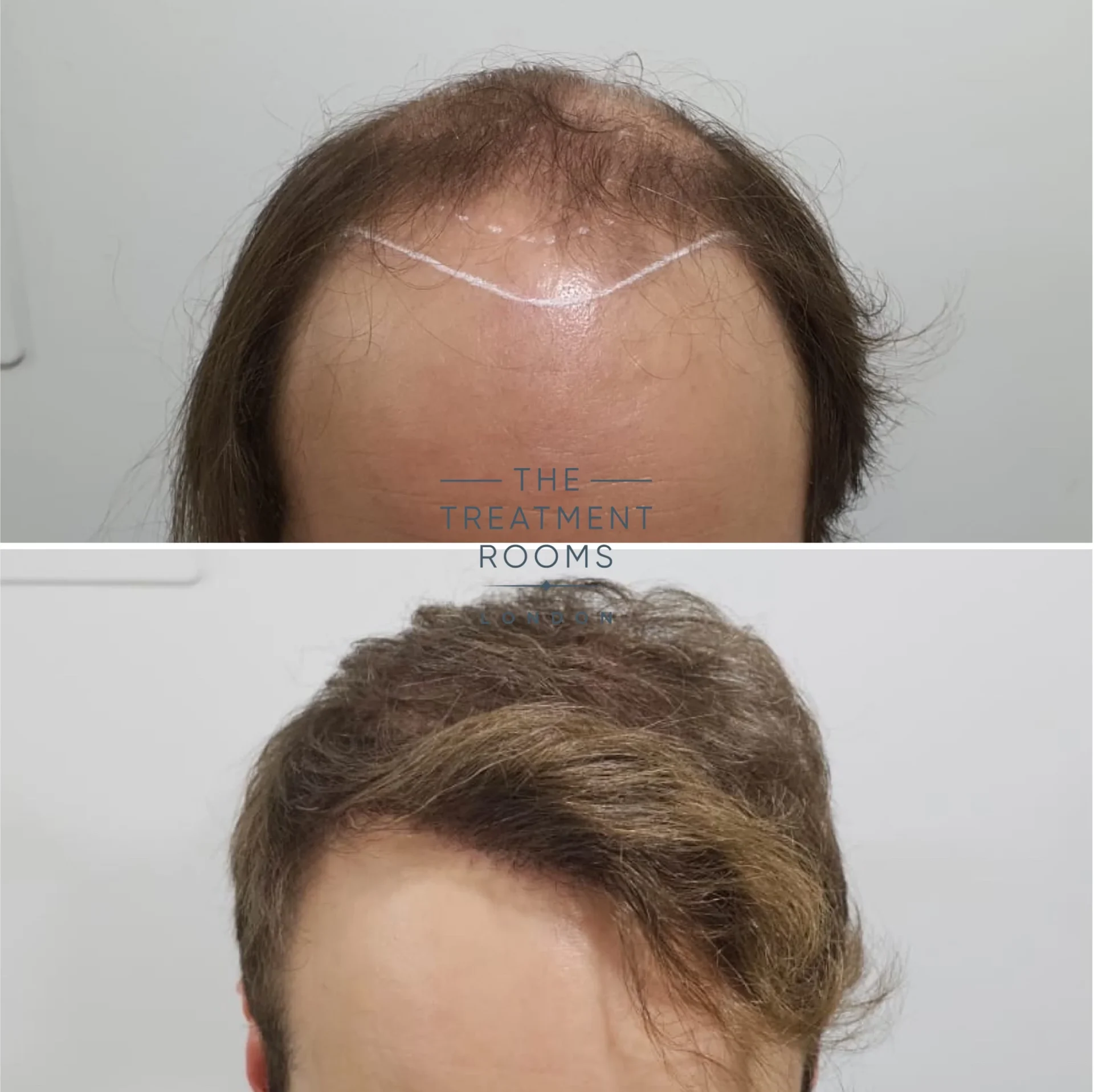 4111 grafts fue hair transplant london hairline and crown
