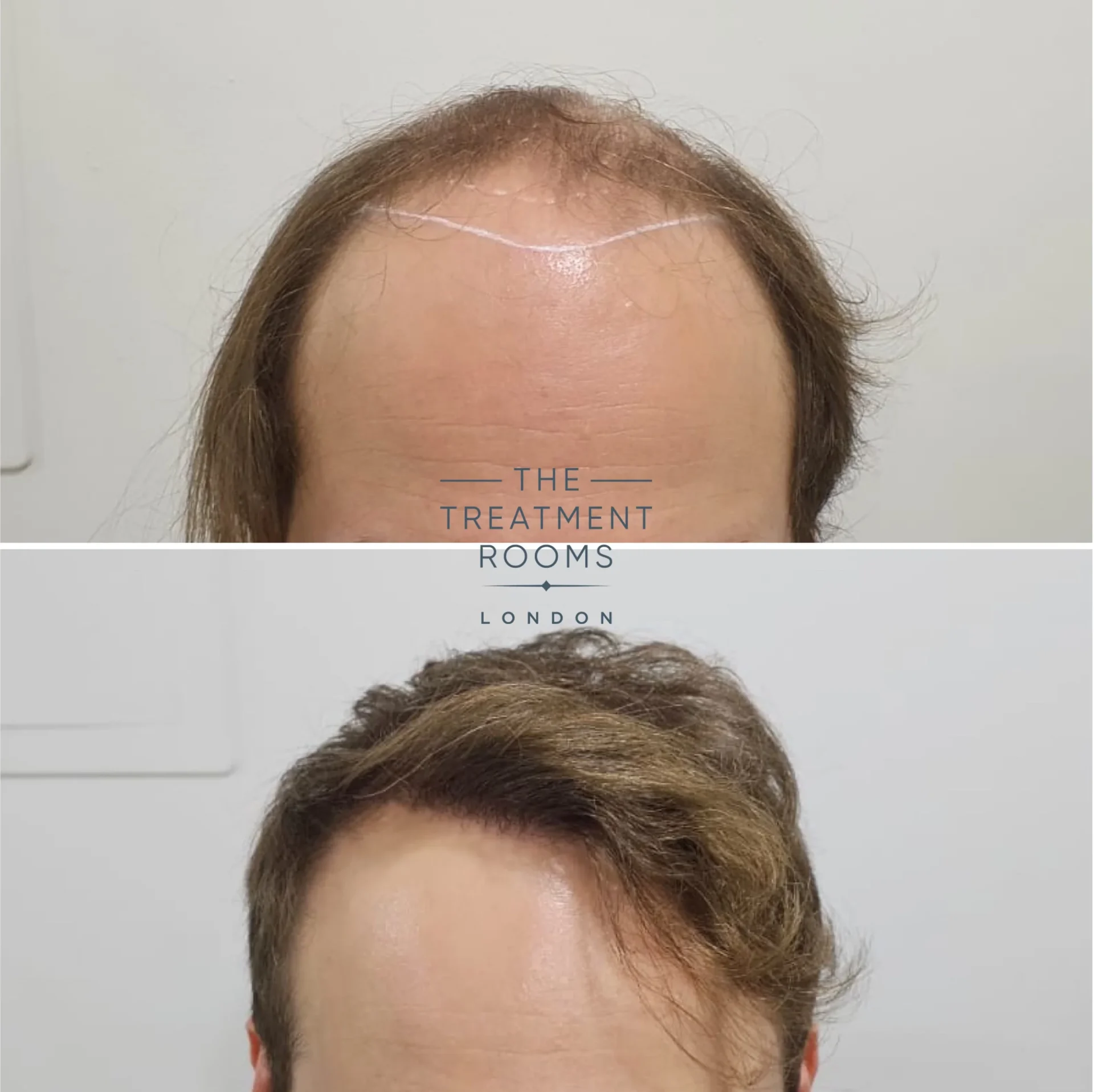 4111 grafts hair transplant hairline and crown before and after
