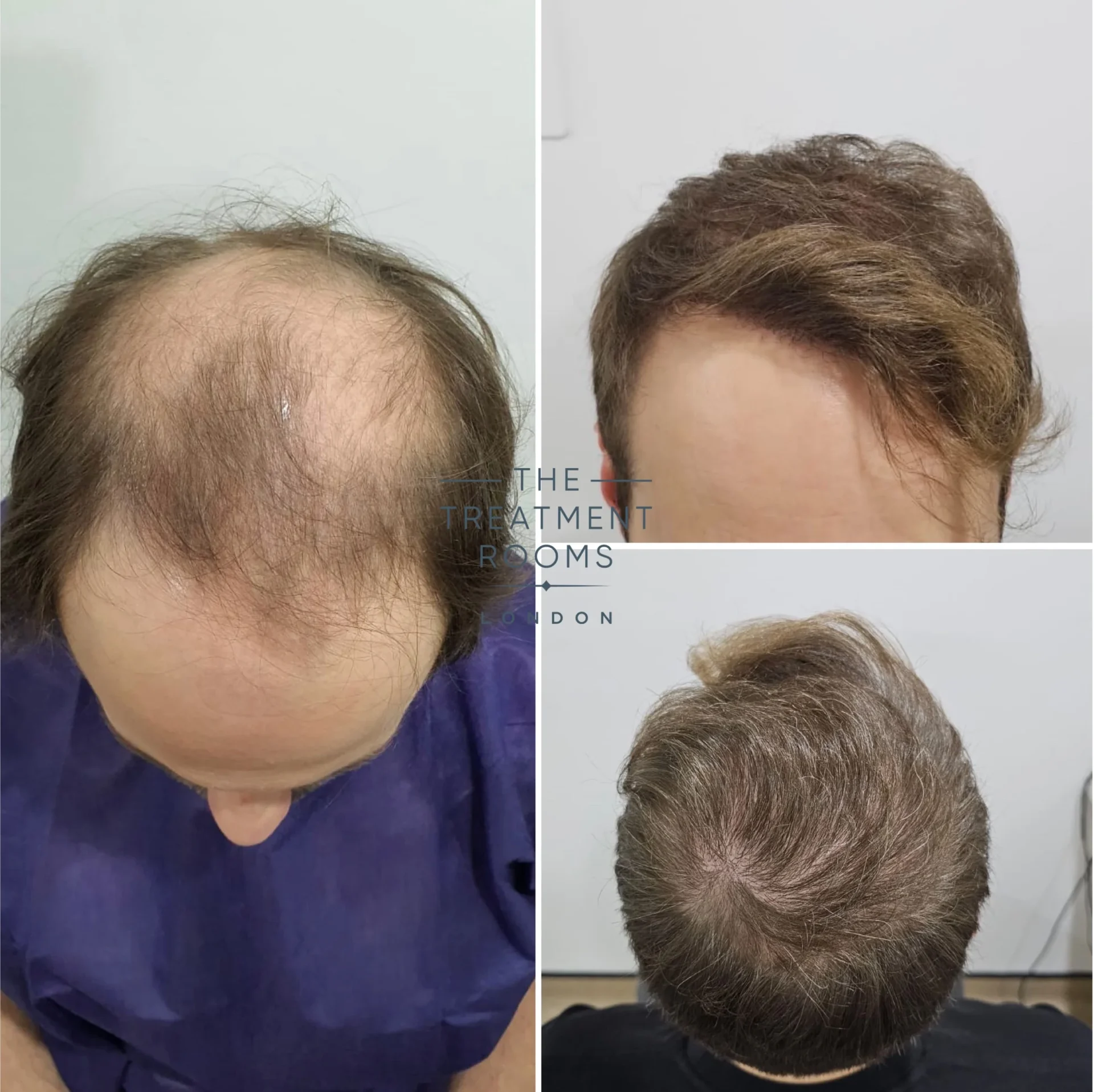4111 grafts hair transplant hairline and crown