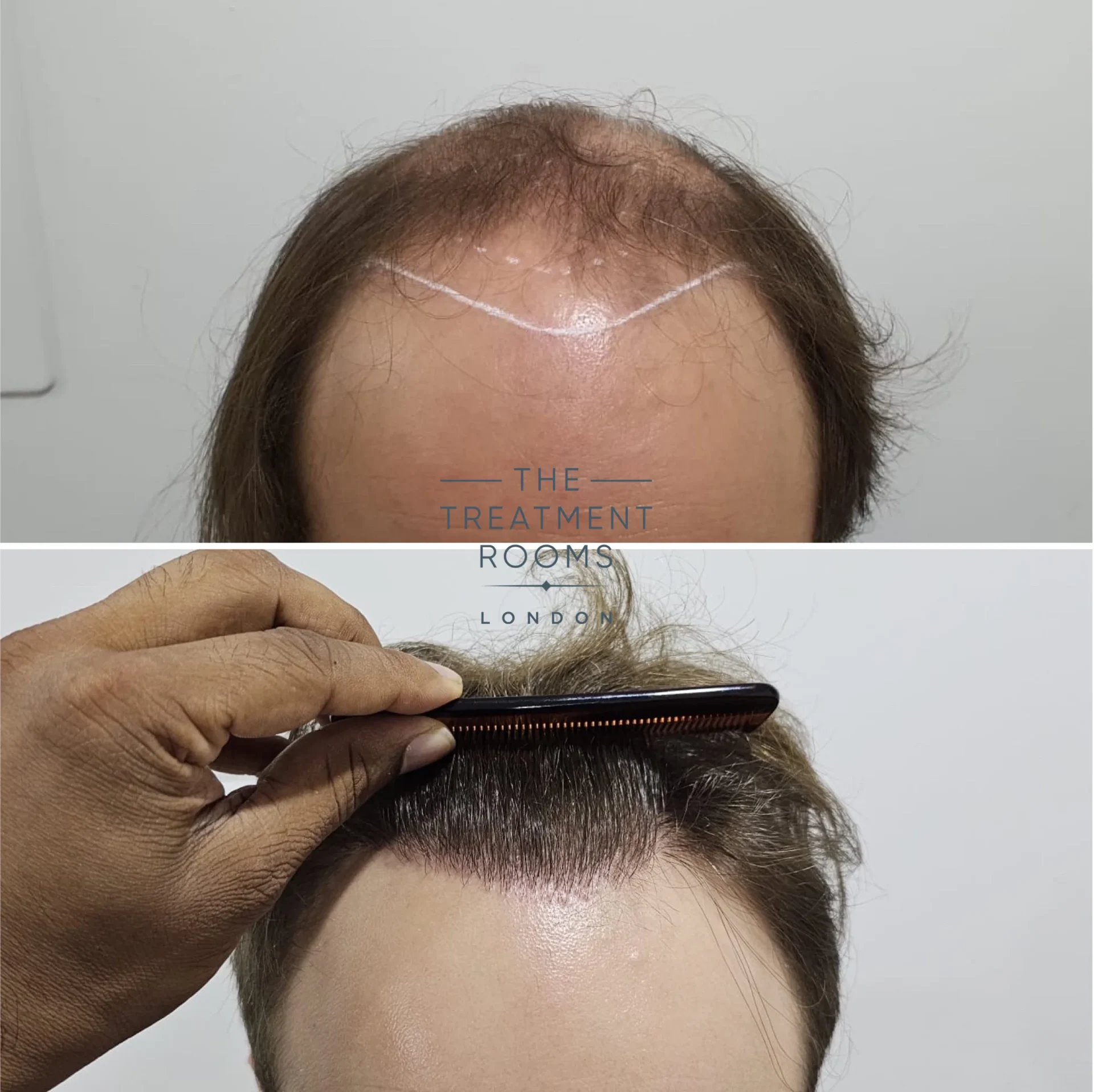 4111 grafts hair transplant london hairline and crown