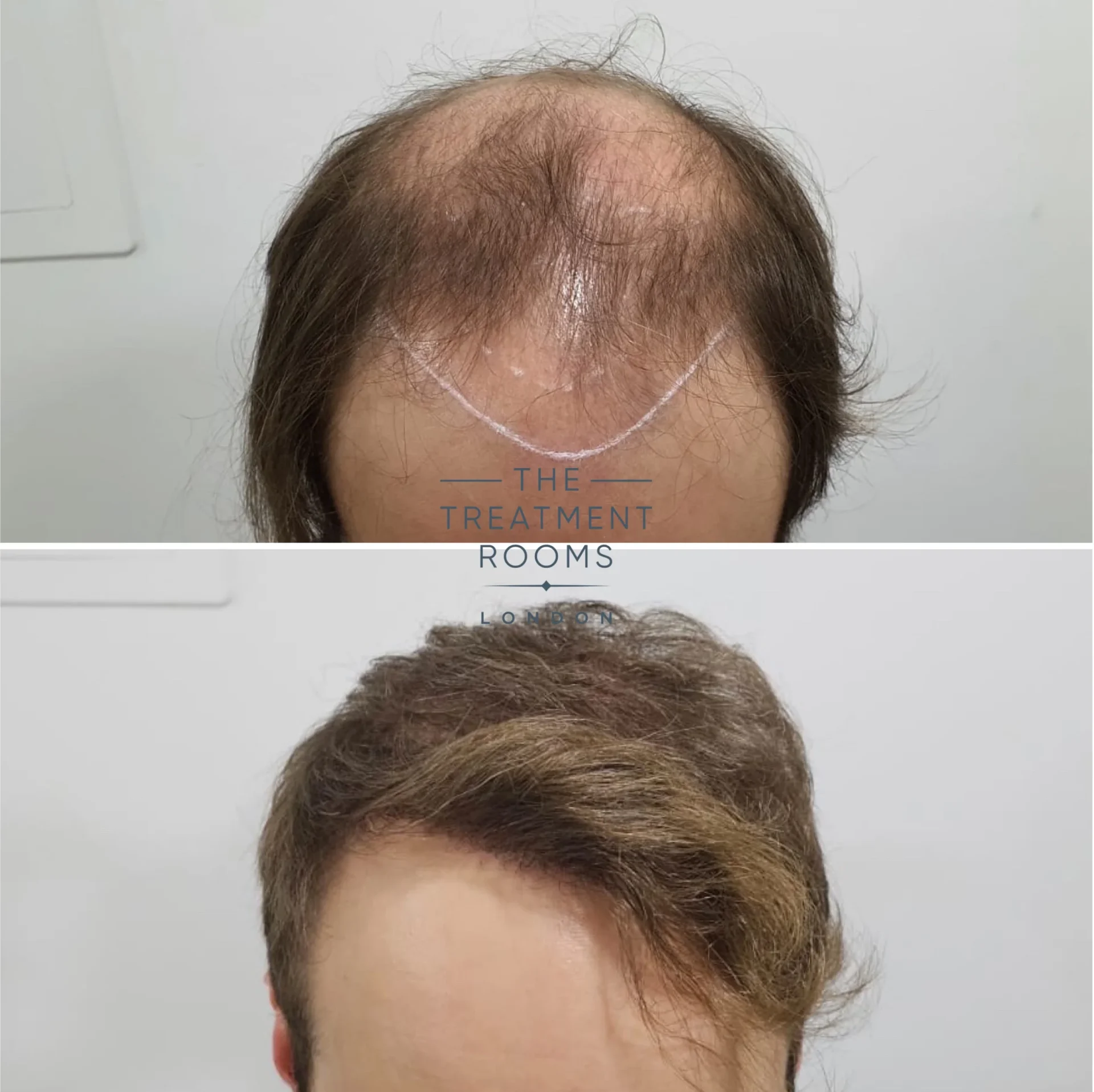 4111 grafts hair transplant london