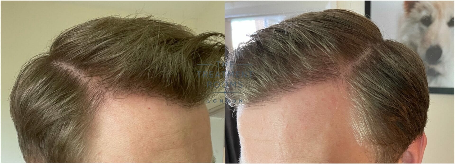 6 months after hair transplant