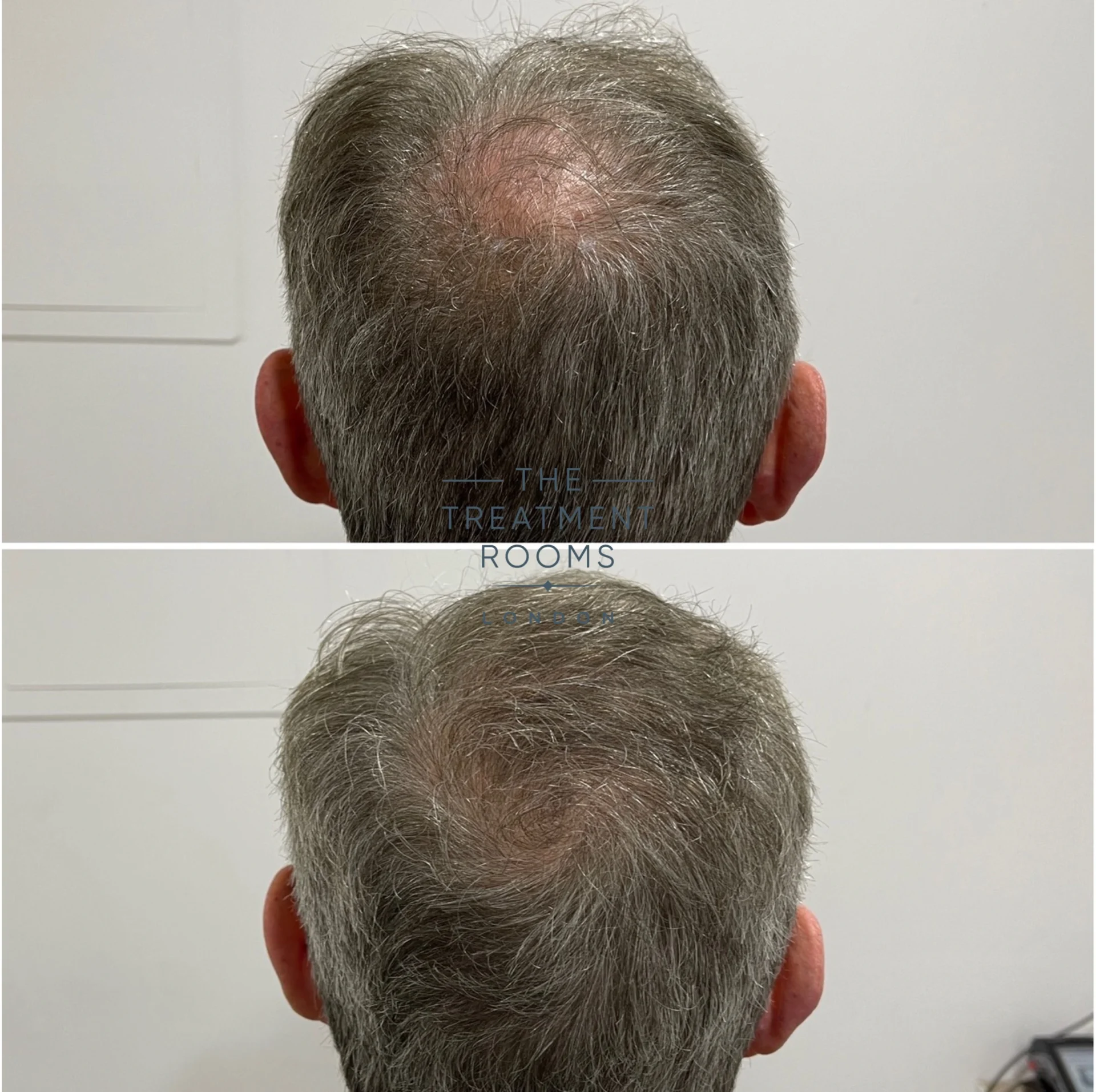 681 grafts hair transplant crown before and after