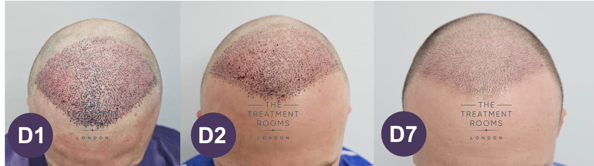 7 days after hair transplant