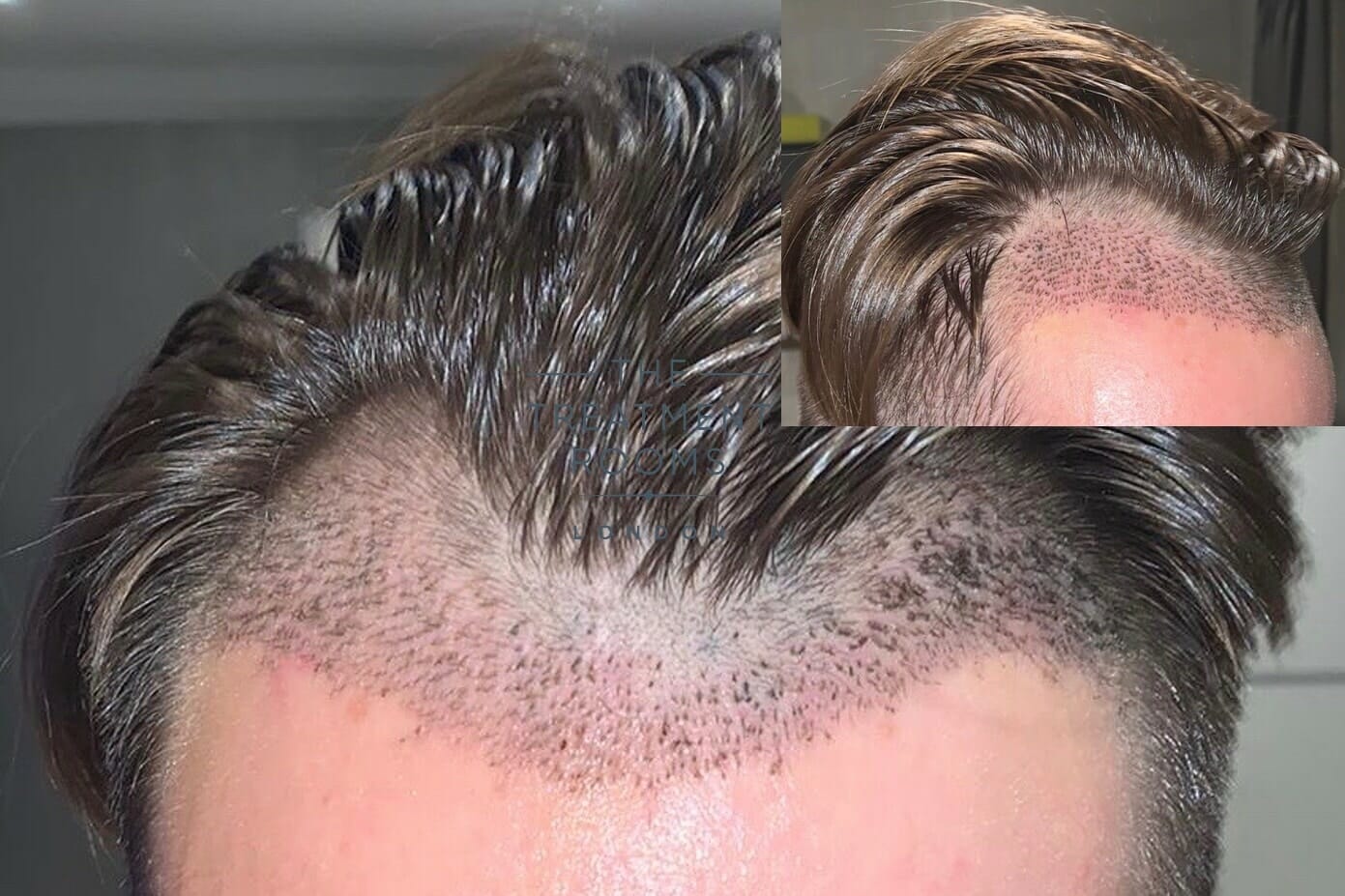 Hair Transplant After 1 Month Photos Results Side Effects