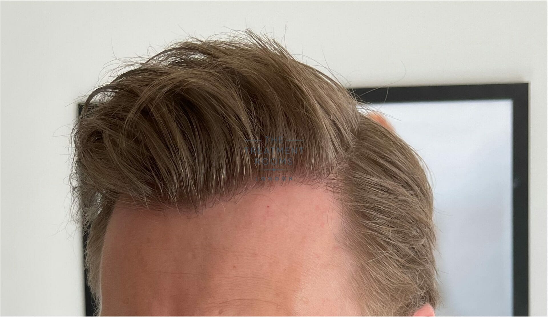 Hair Transplant Result Before and After at DERMACLINIX