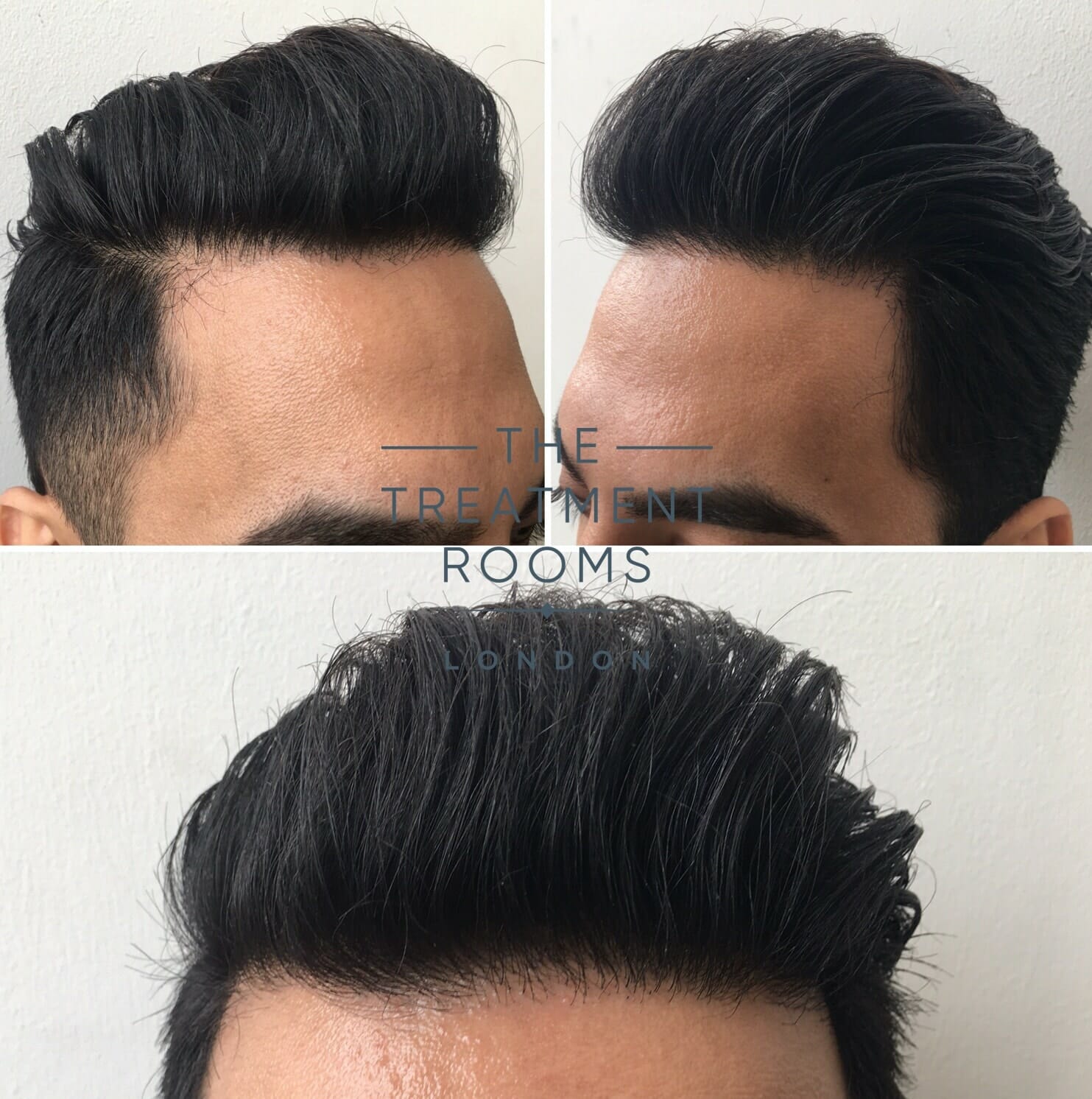 After FUE Hair transplant London hairline
