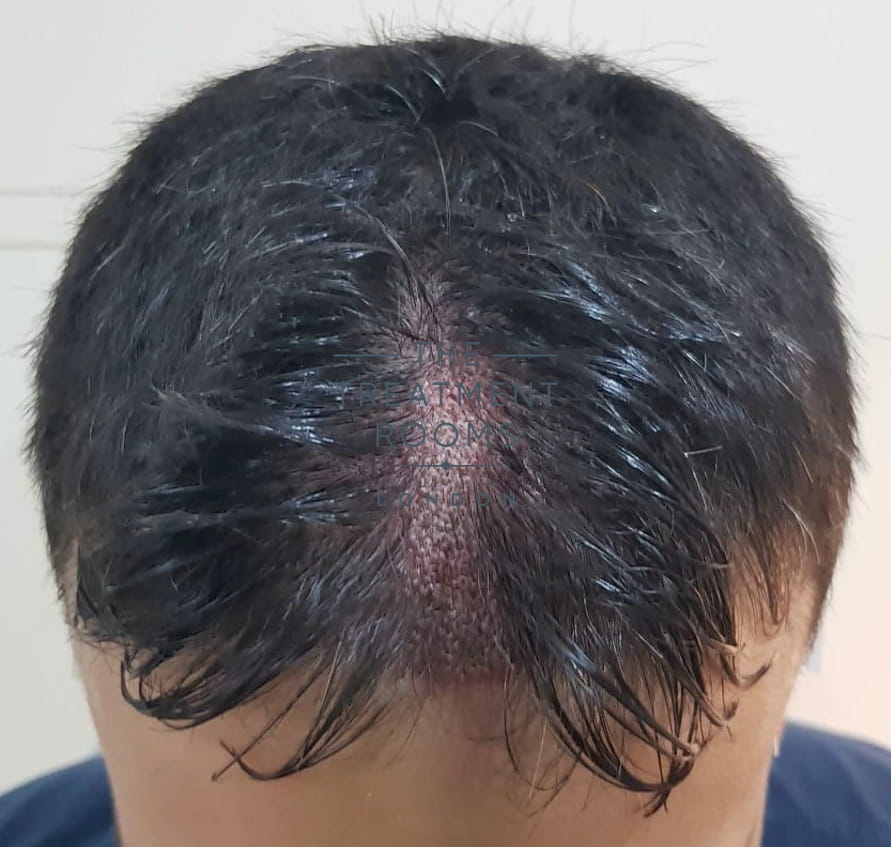 After FUE hair transplant