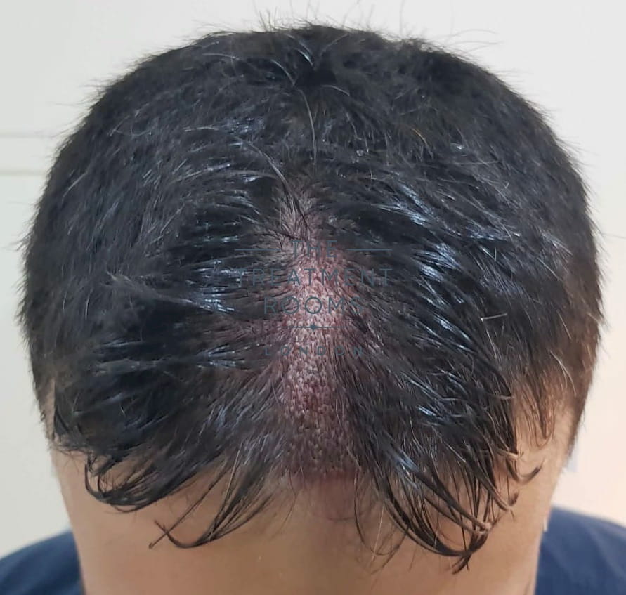 After FUE hair transplant After FUE hair transplant