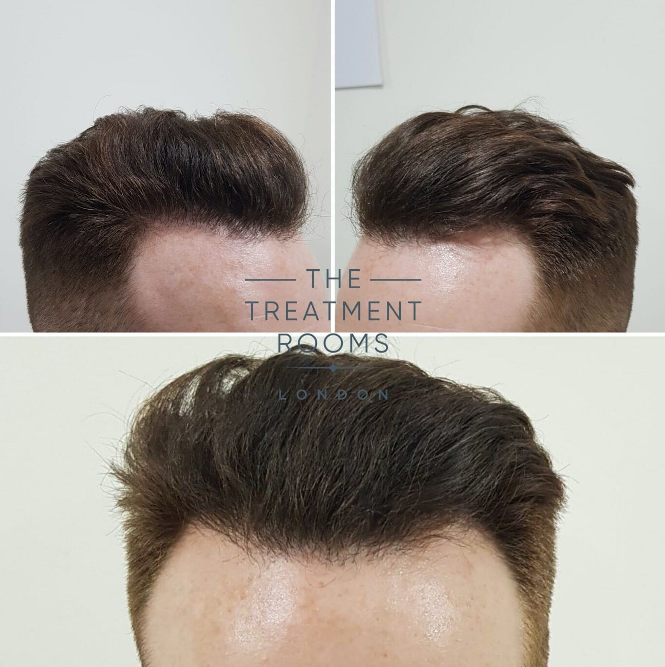 After FUE hair transplant front and temporal hairline