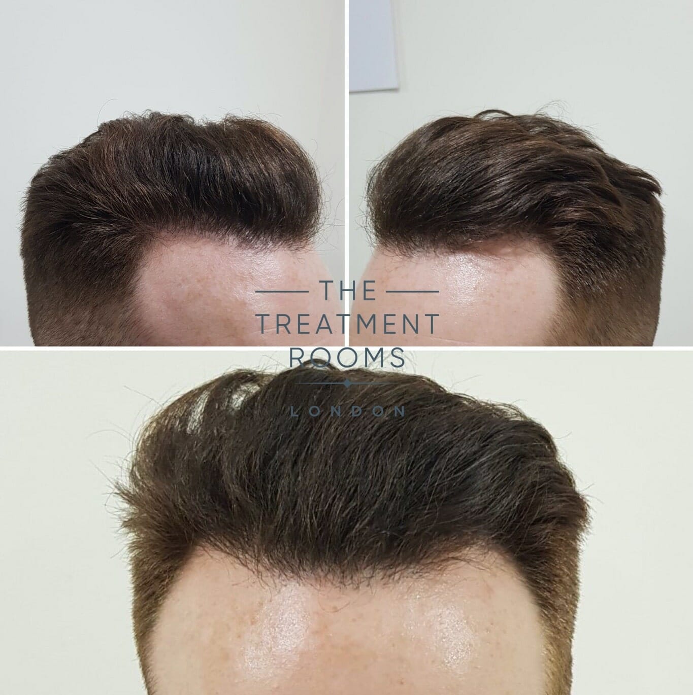 After FUE hair transplant front and temporal hairline After FUE hair transplant front and temporal hairline
