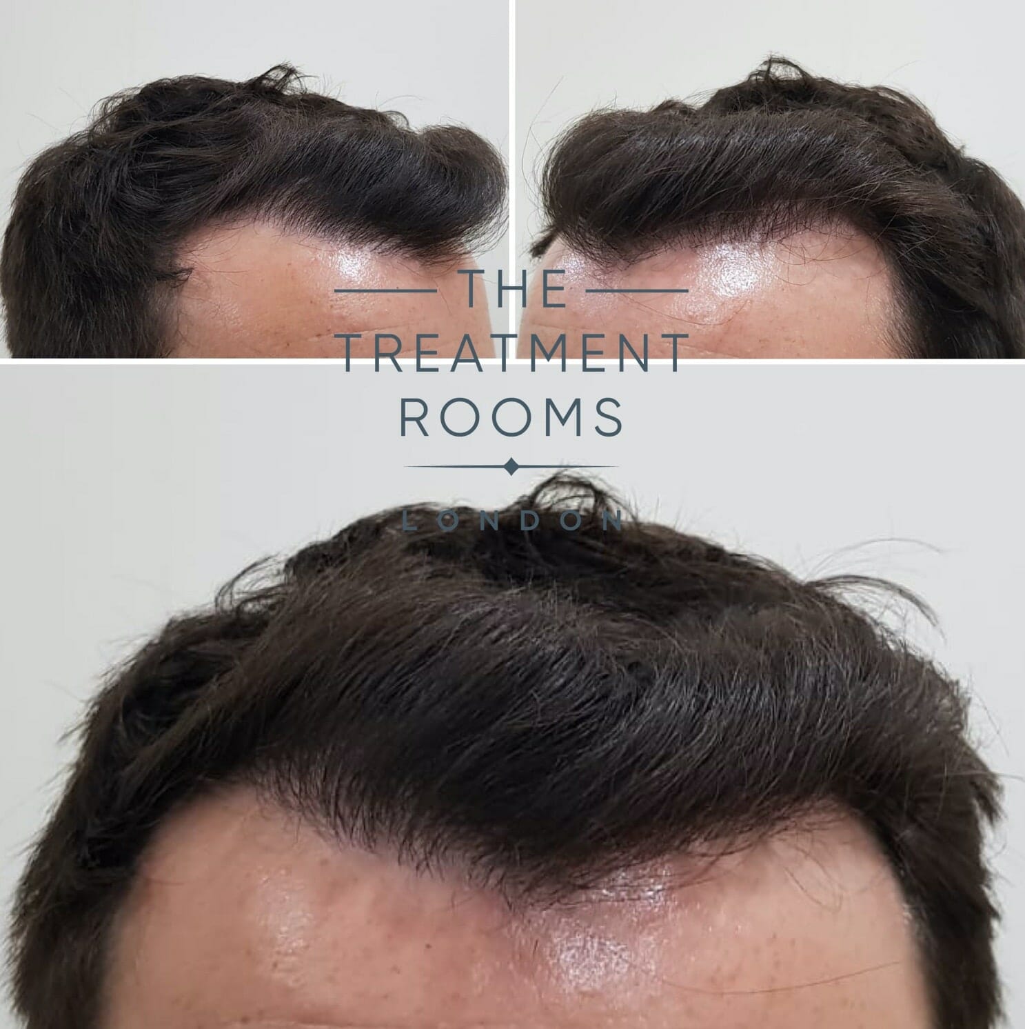 After FUE hair transplant in London After FUE hair transplant in London