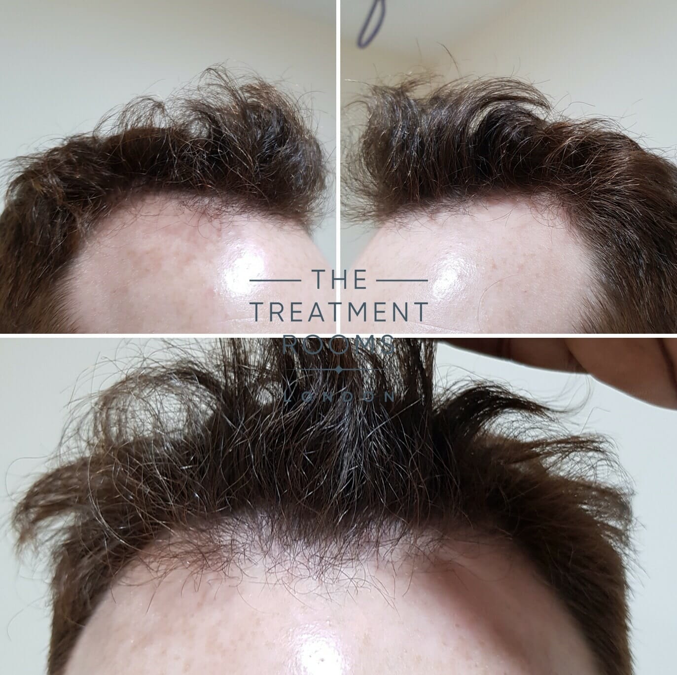 Before FUE hair transplant front and temporal regions