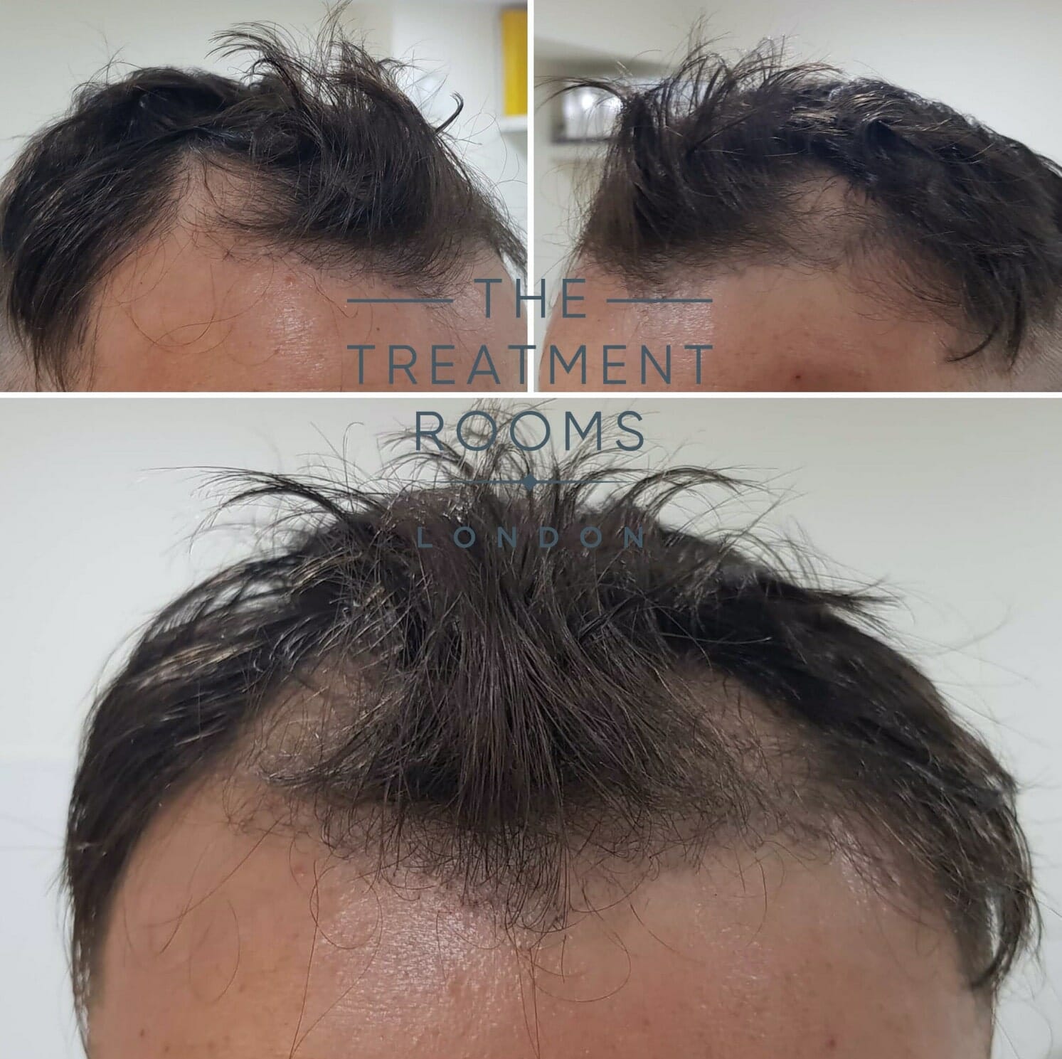 Before Hair Transplant front and temples